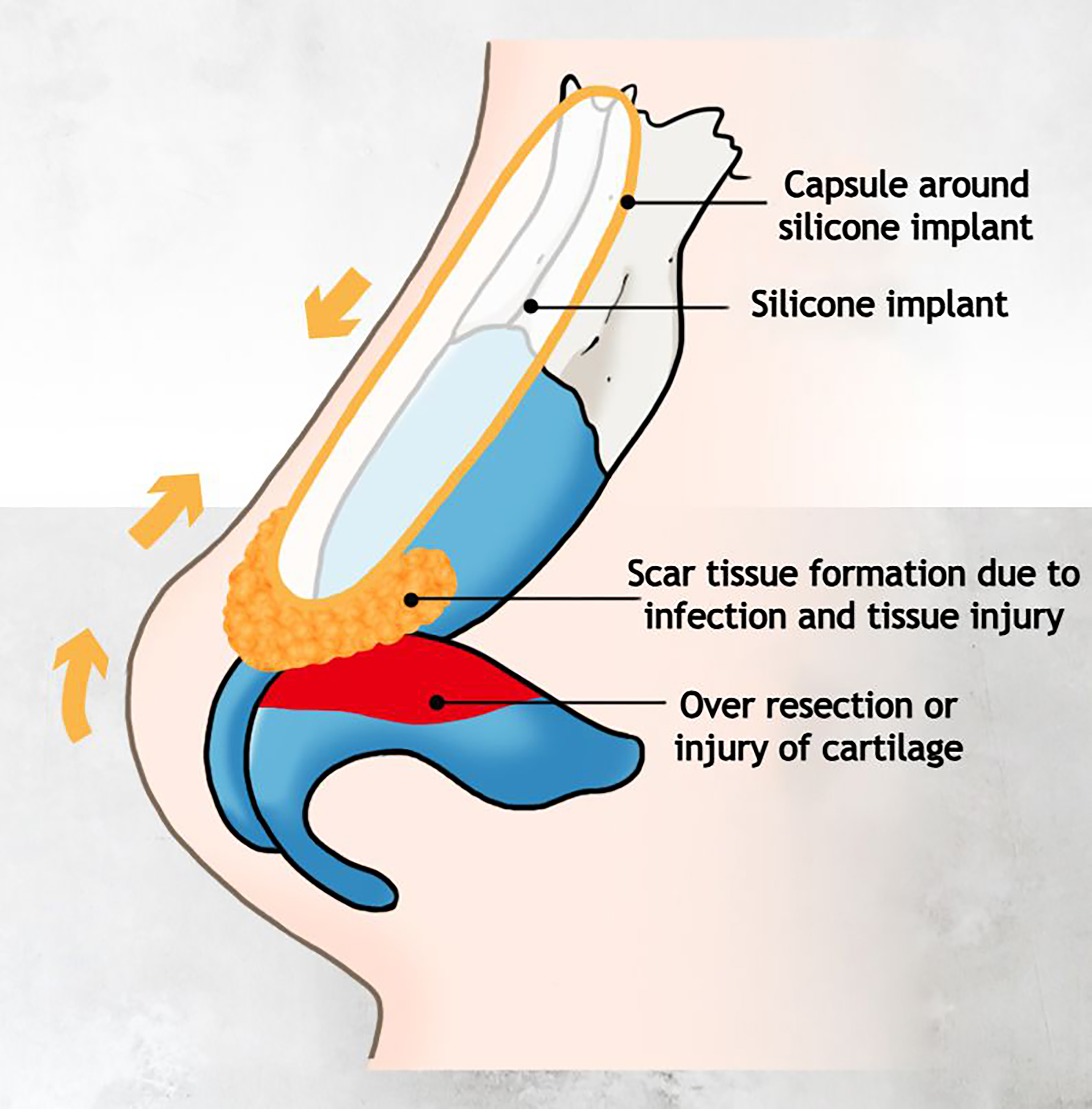 Reconstructive rhinoplasty for the contracted Asian nose