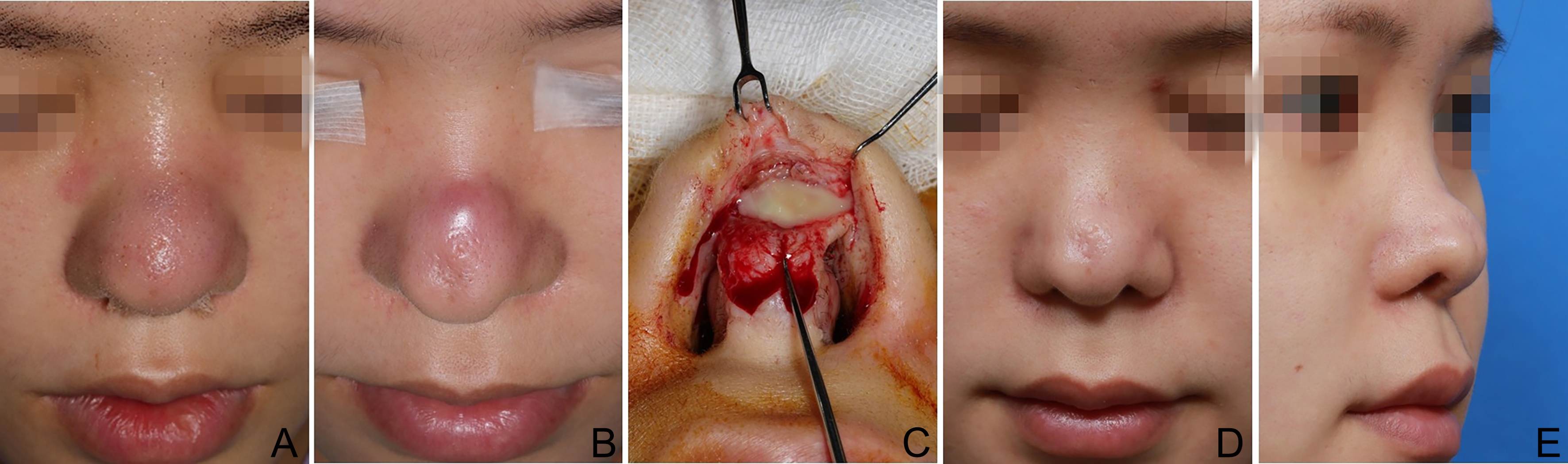 Reconstructive rhinoplasty for the contracted Asian nose
