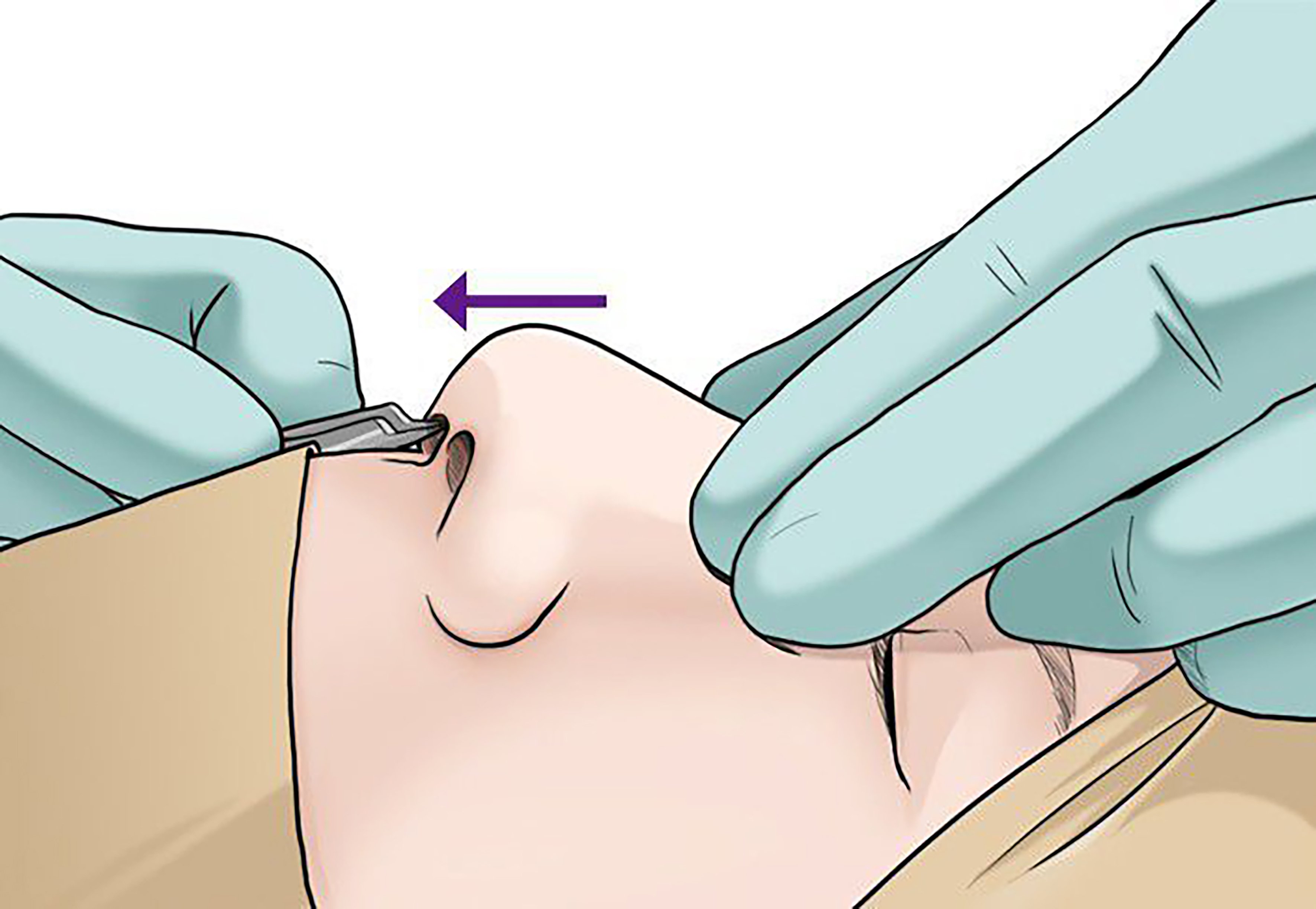 Reconstructive rhinoplasty for the contracted Asian nose