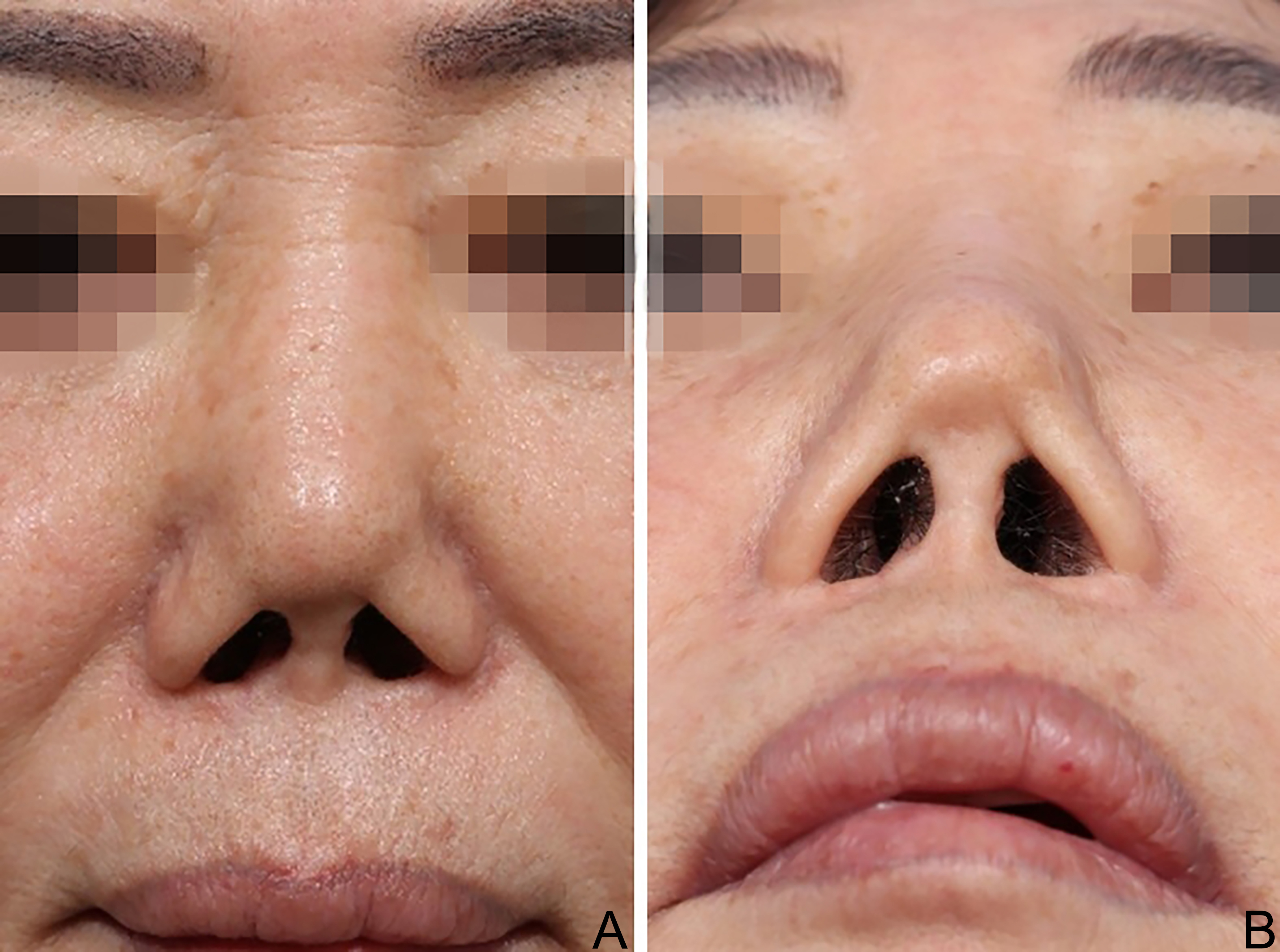 Reconstructive rhinoplasty for the contracted Asian nose