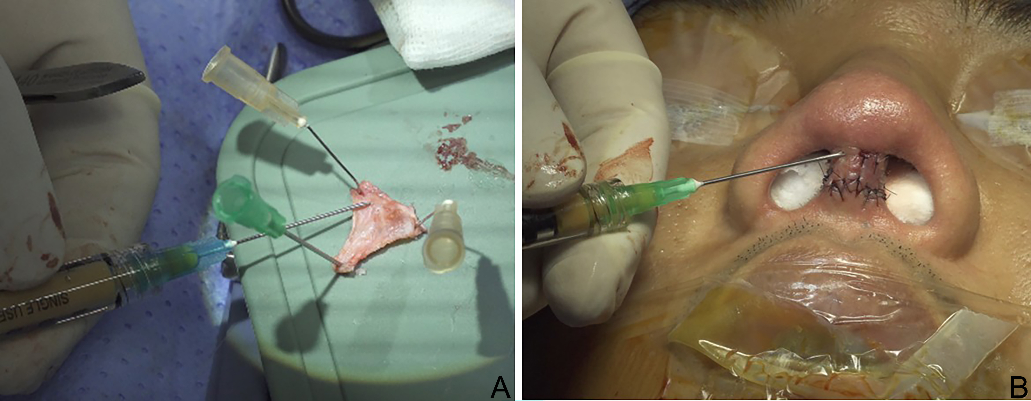 Reconstructive rhinoplasty for the contracted Asian nose