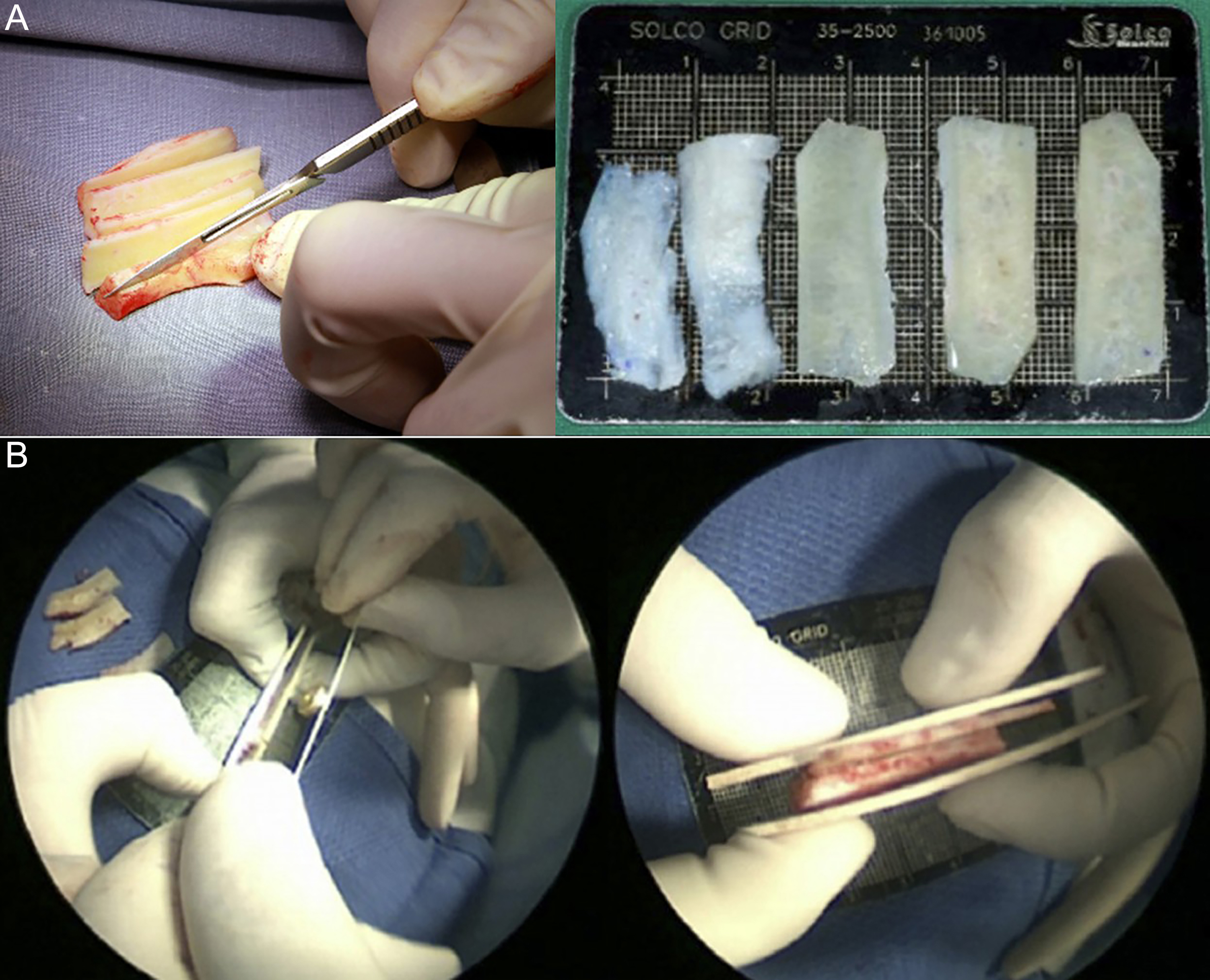 Reconstructive rhinoplasty for the contracted Asian nose
