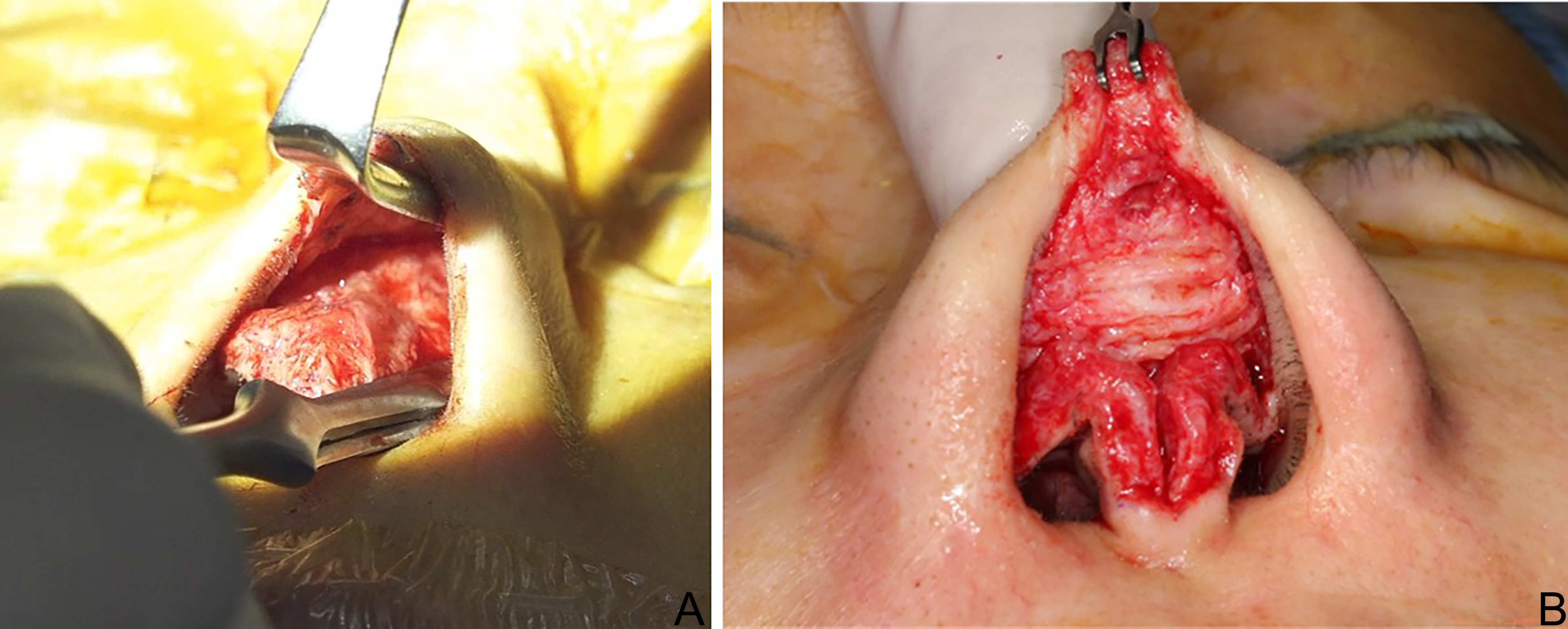 Reconstructive rhinoplasty for the contracted Asian nose