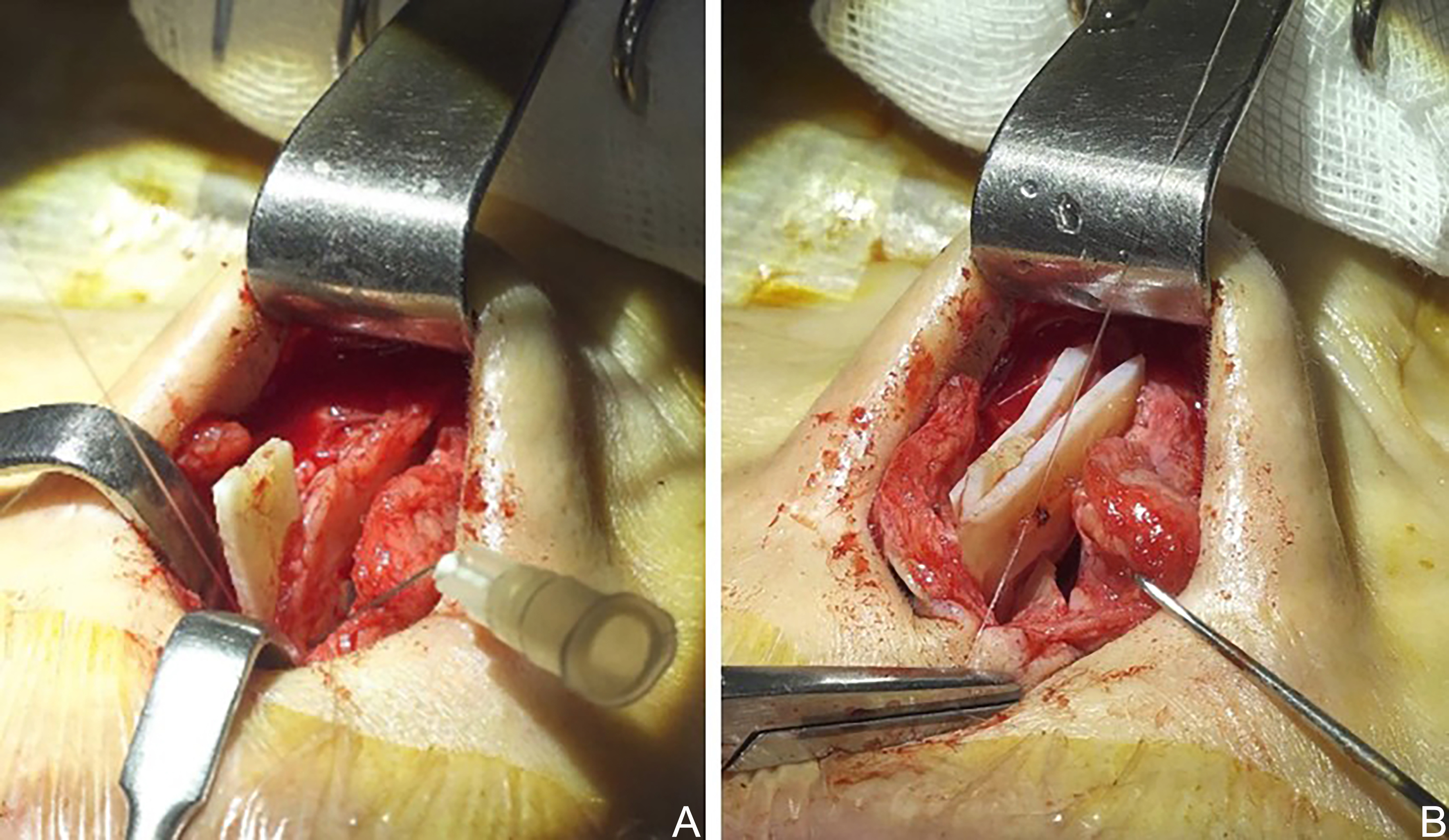 Reconstructive rhinoplasty for the contracted Asian nose