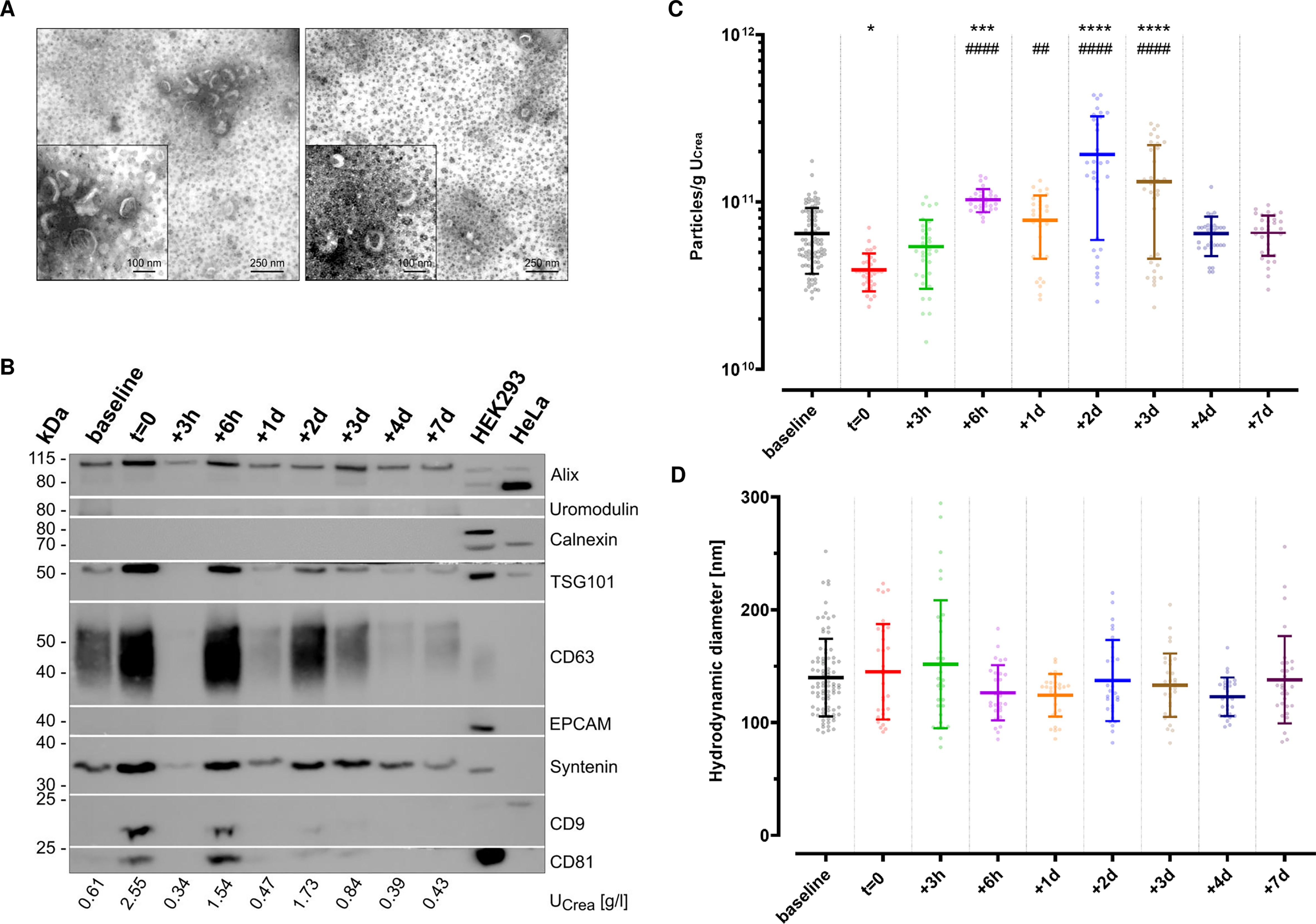 Impact of autologous blood transfusions on surface marker and microRNA profiles of urinary extracellular vesicles