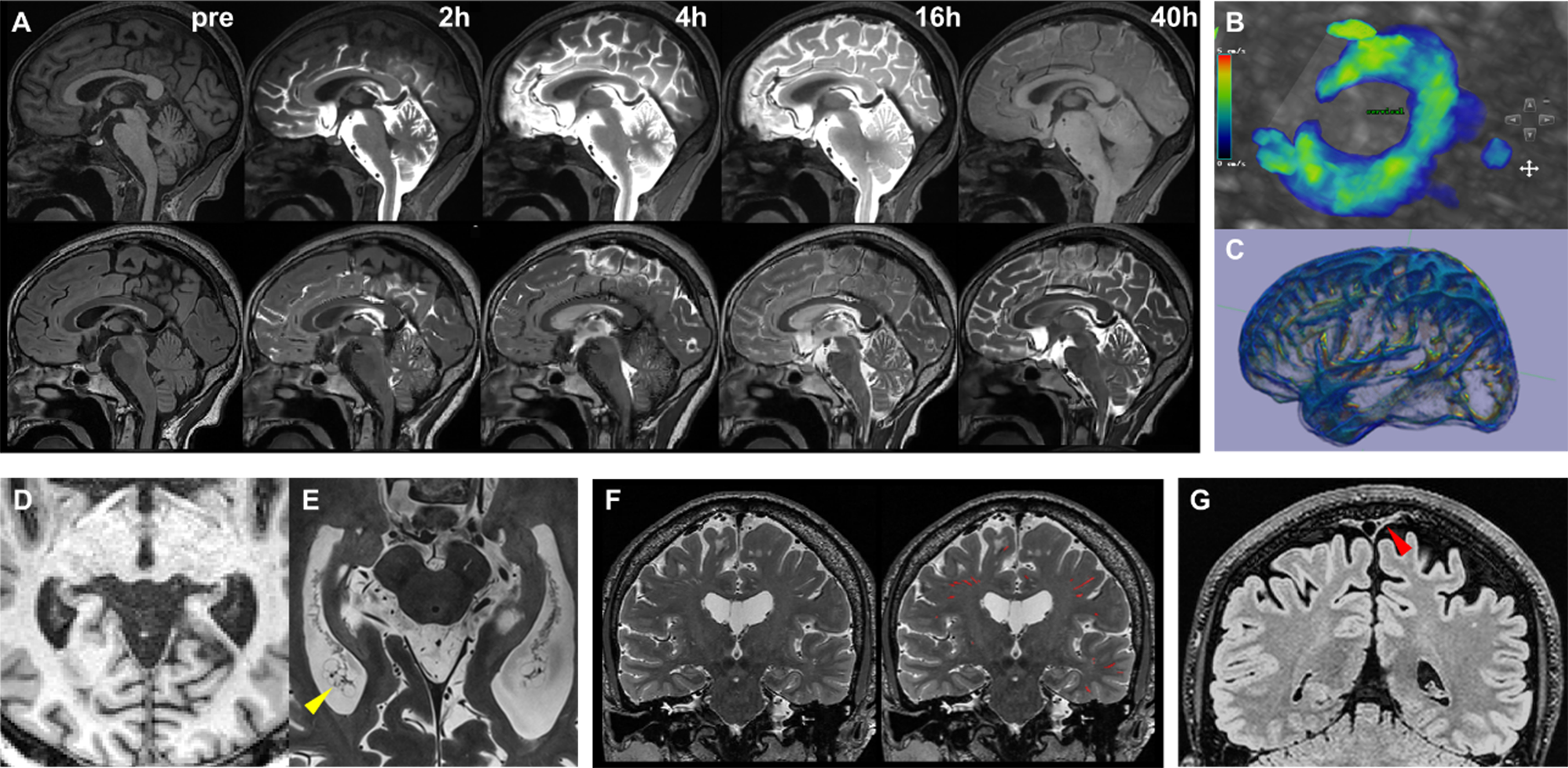 Imaging brain waste clearance in neurodegenerative diseases