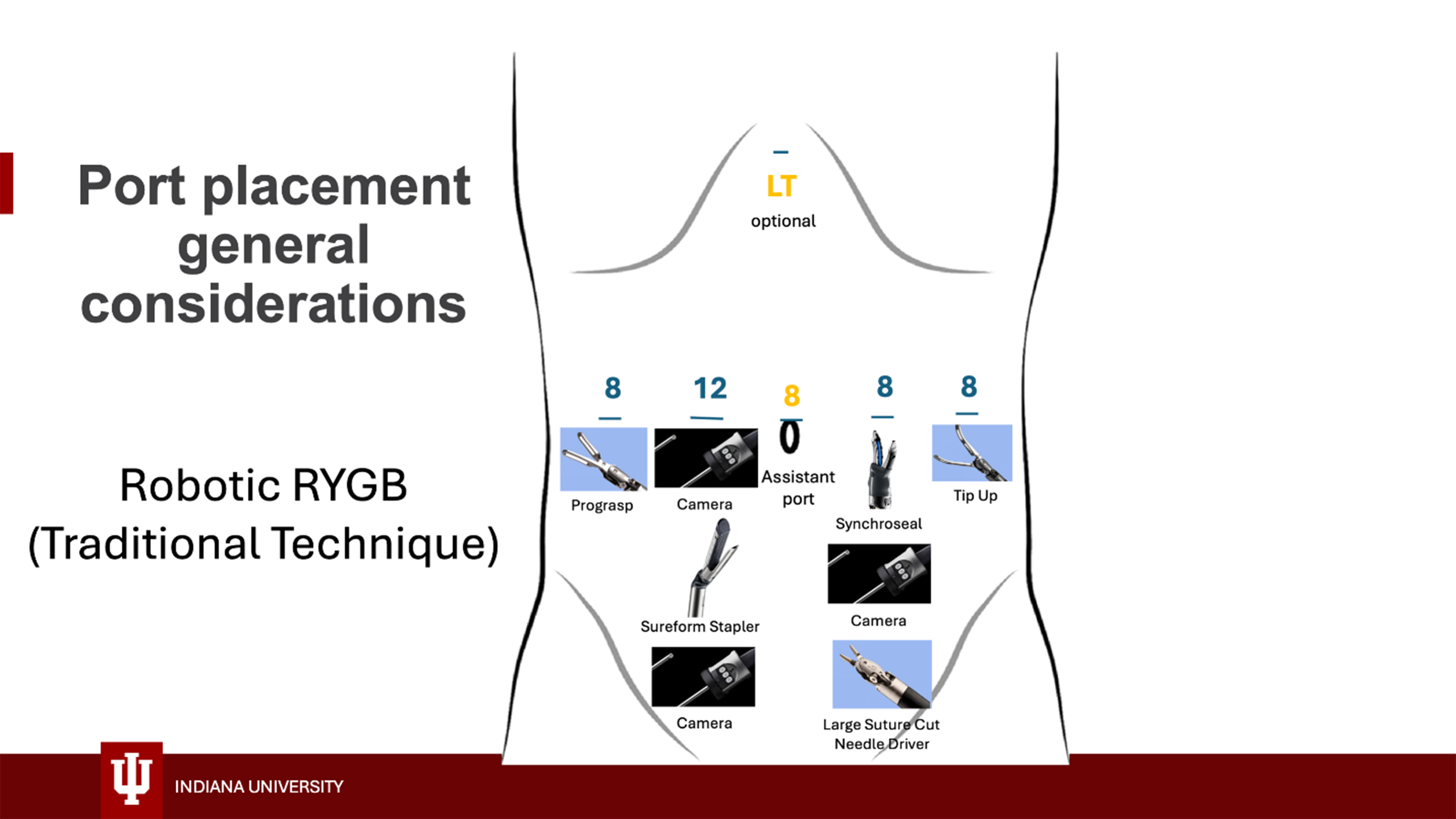 Technical considerations for robotic gastric bypass: comparing traditional and omega loop techniques