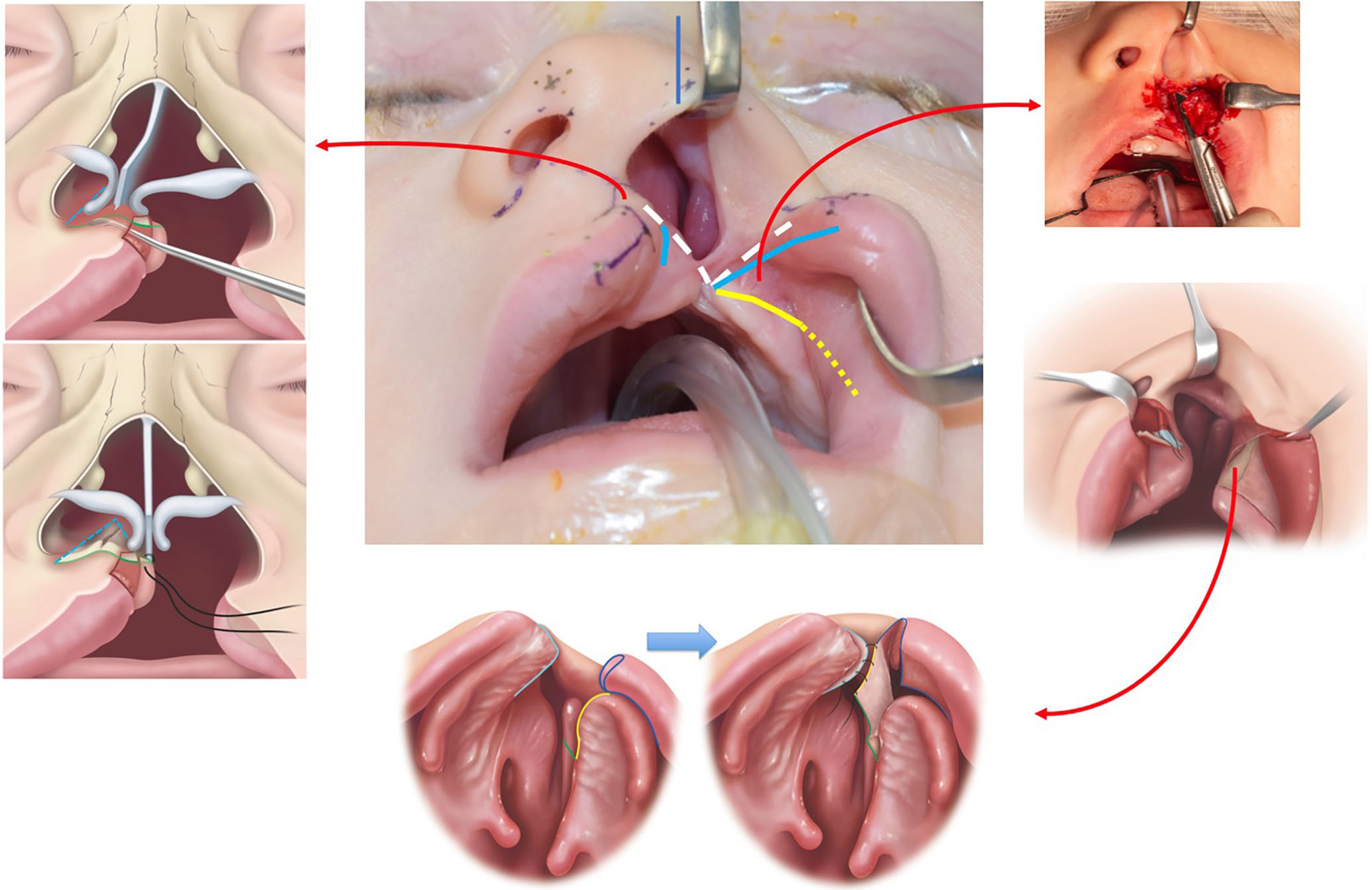 Congenital nasal deformities: advances in early surgical intervention