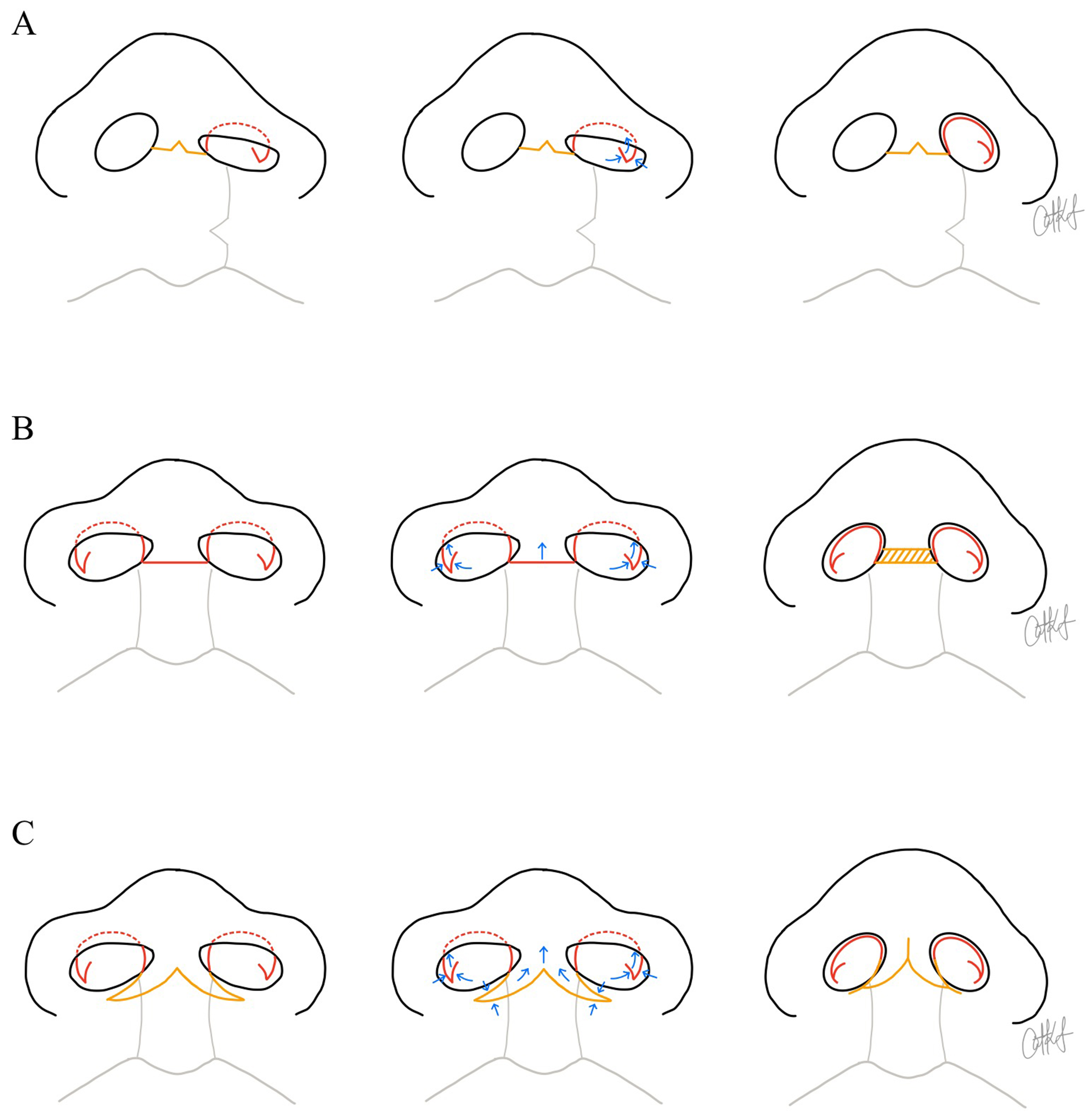 Congenital nasal deformities: advances in early surgical intervention