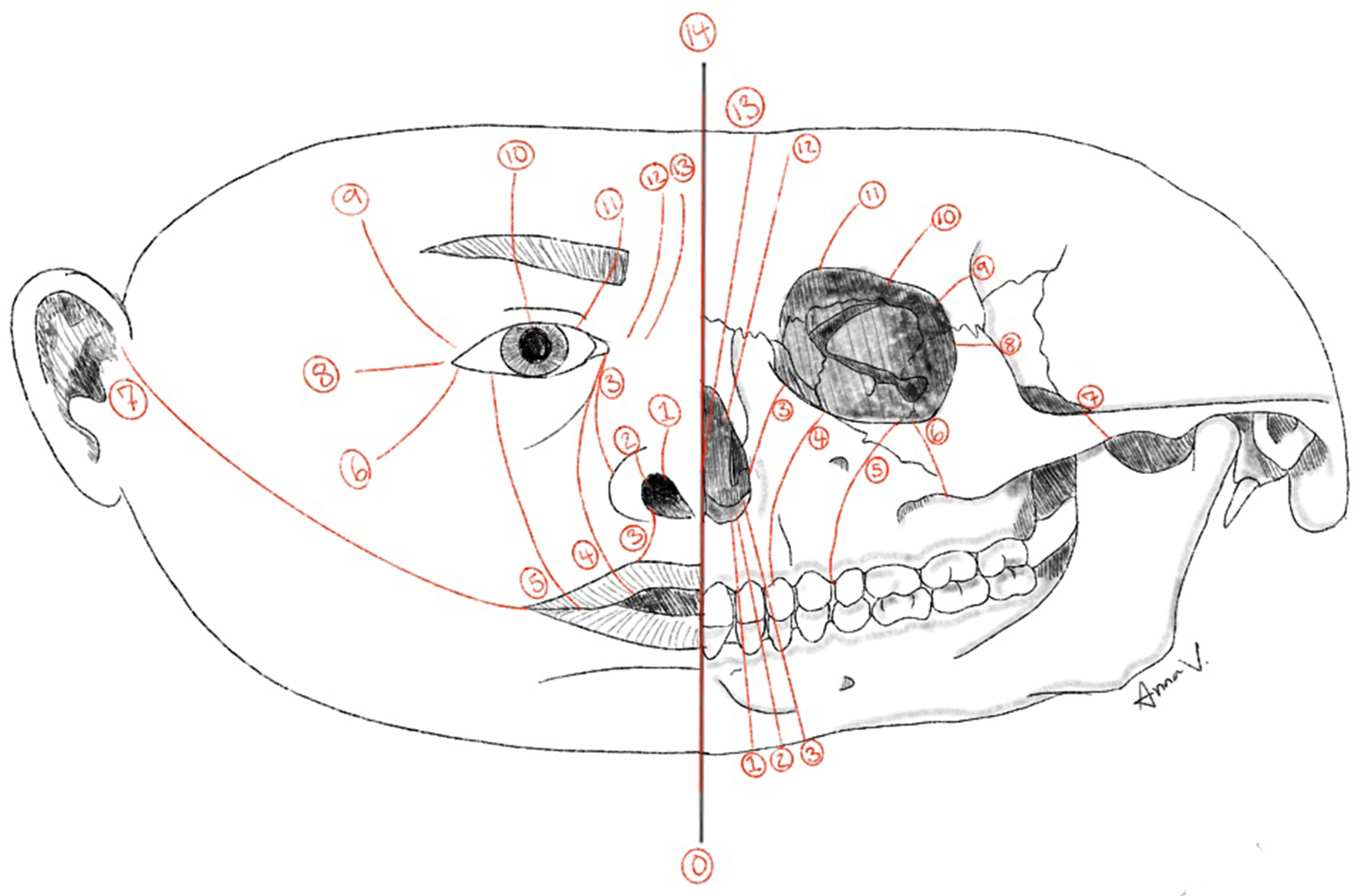Congenital nasal deformities: advances in early surgical intervention
