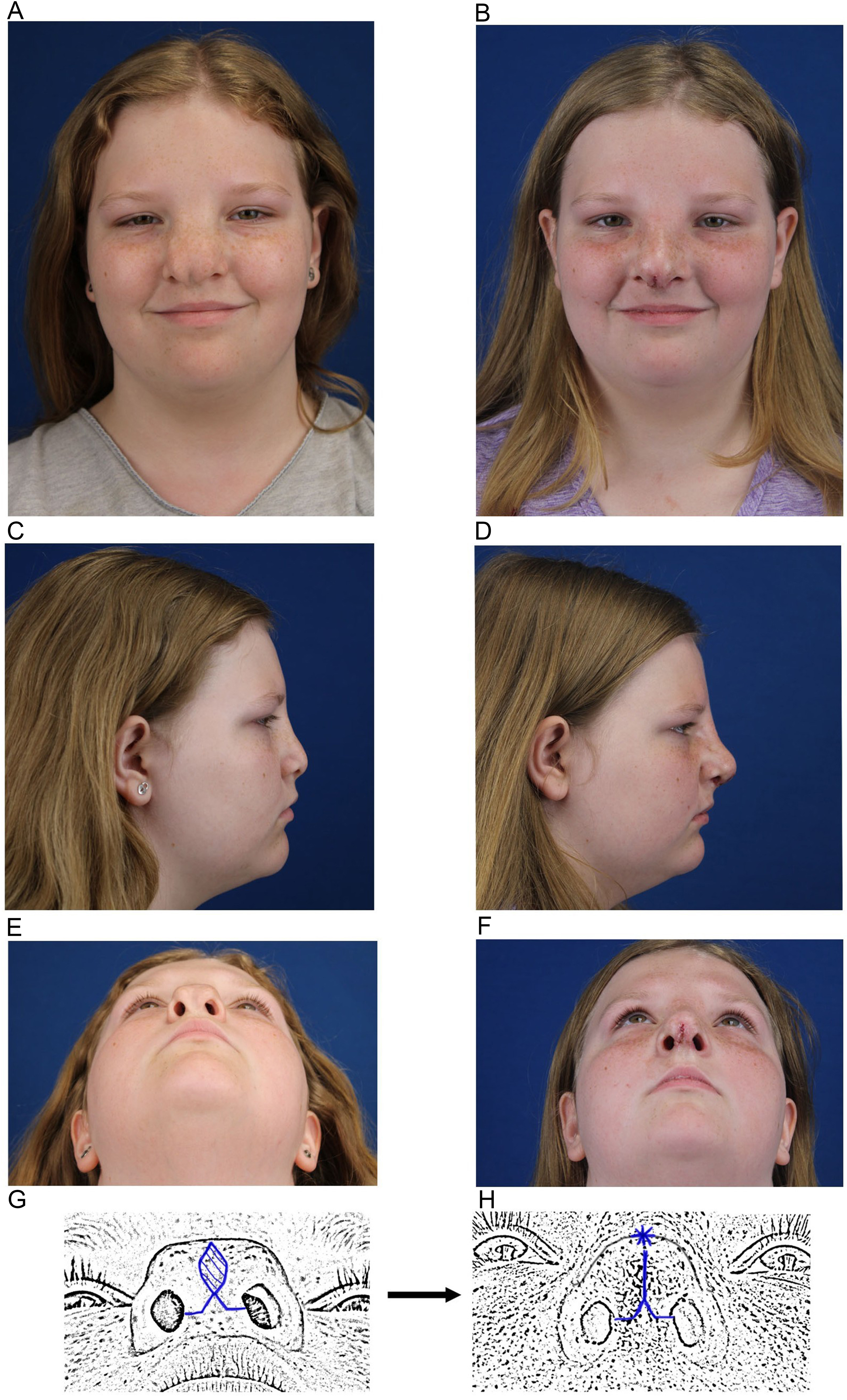 Congenital nasal deformities: advances in early surgical intervention