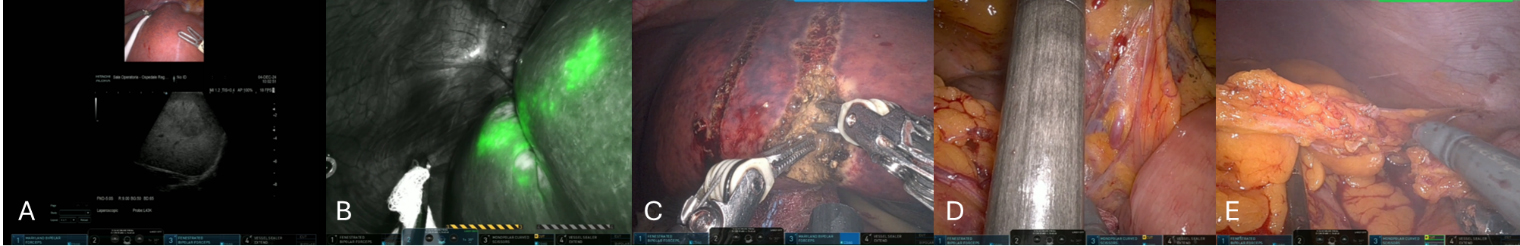 Simultaneous robotic liver resection and left colectomy for sigmoid colon cancer with synchronous liver metastases using the same robotic trocar positioning
