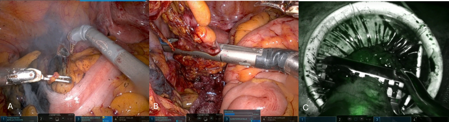 Simultaneous robotic liver resection and left colectomy for sigmoid colon cancer with synchronous liver metastases using the same robotic trocar positioning