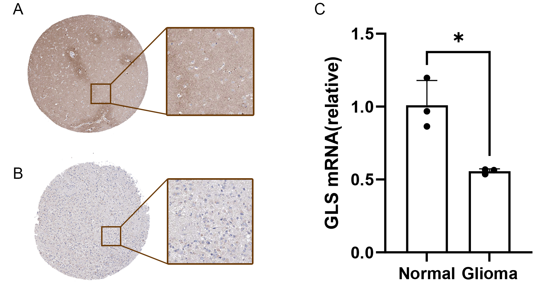 Cuproptosis-related gene-based characterization and diagnostic biomarker screening in gliomas