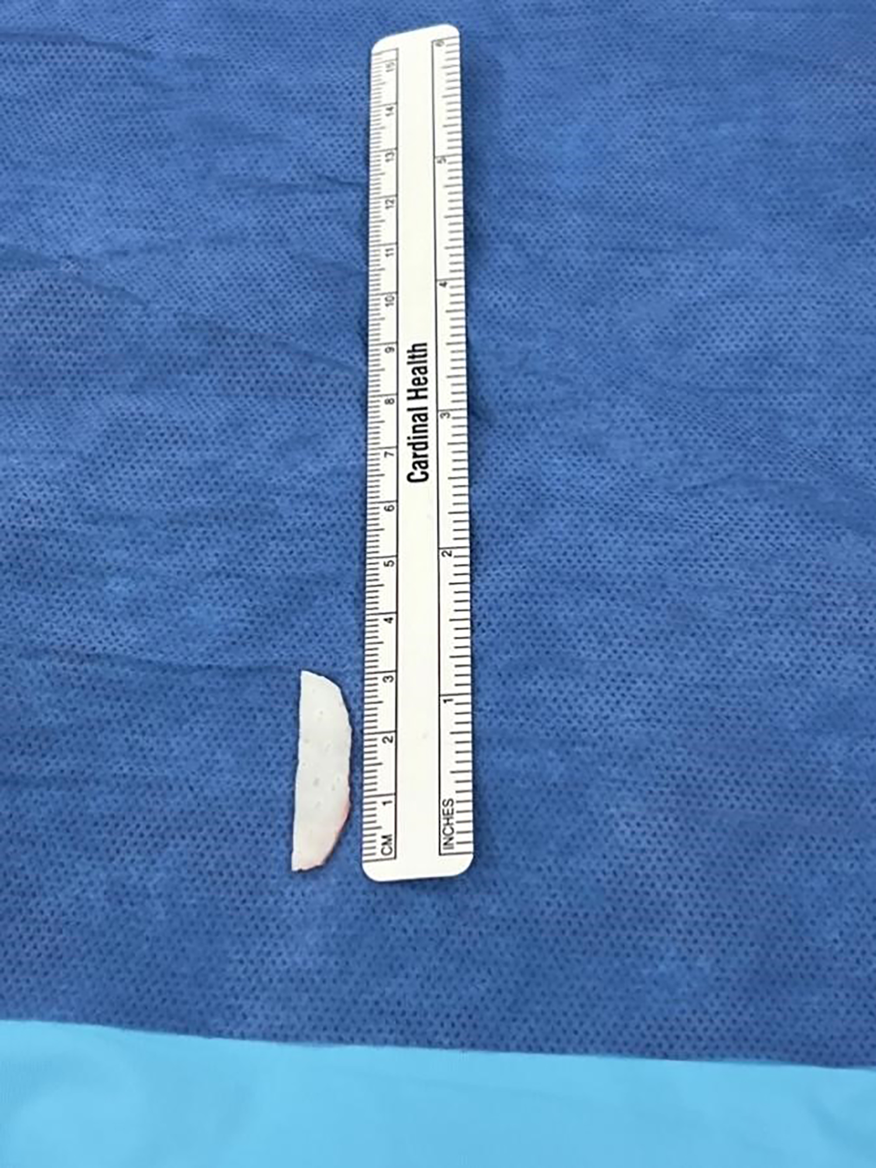 Use of biomaterials for paralyzed lower eyelid reconstruction