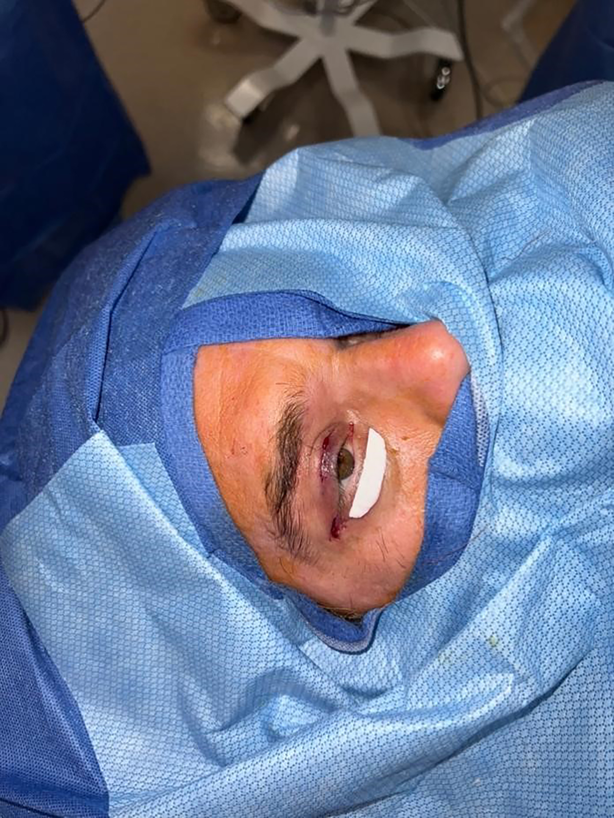 Use of biomaterials for paralyzed lower eyelid reconstruction