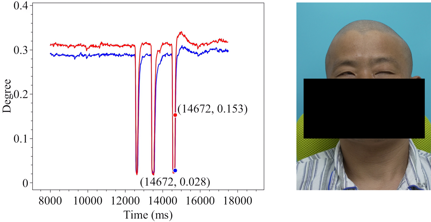 Assistive assessment of neurological dysfunction via eye movement patterns and ocular biometrics