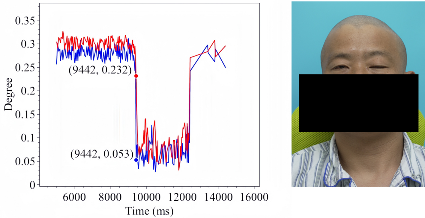 Assistive assessment of neurological dysfunction via eye movement patterns and ocular biometrics