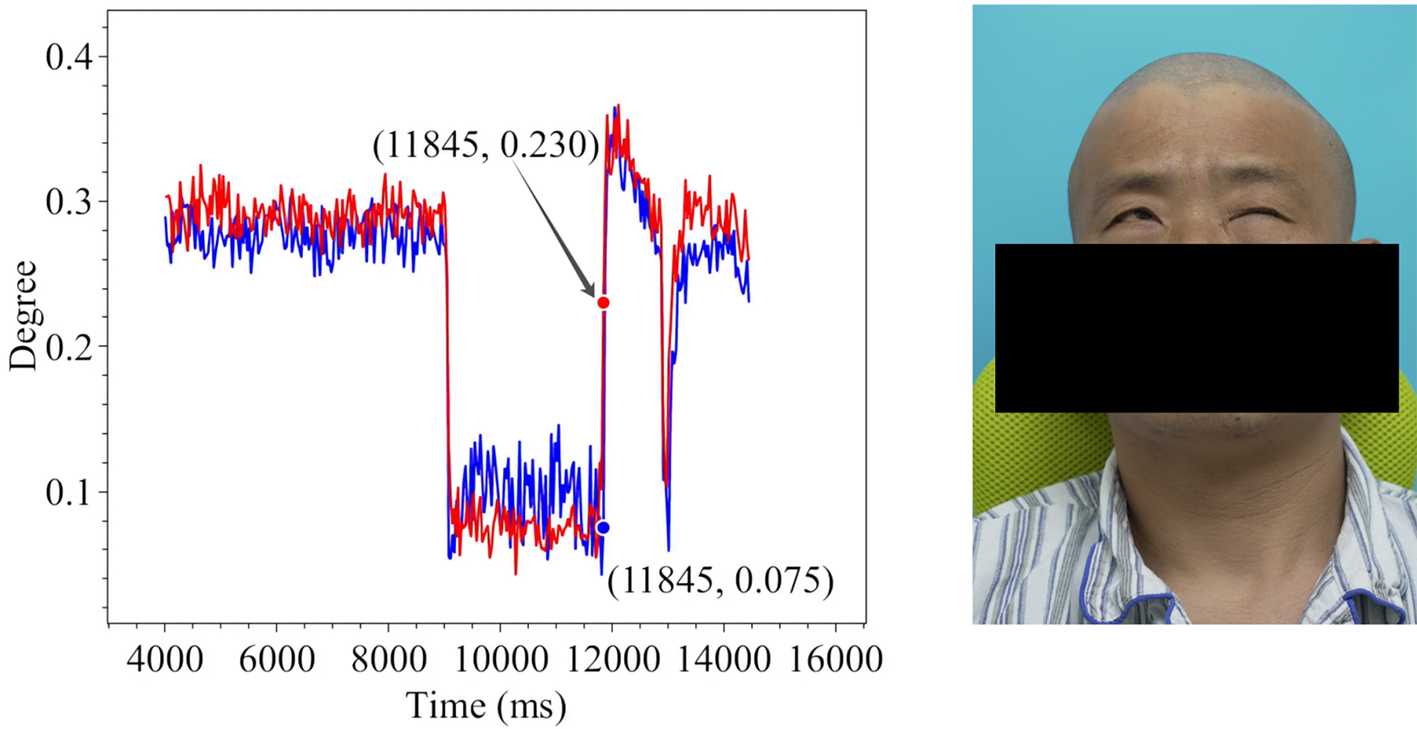 Assistive assessment of neurological dysfunction via eye movement patterns and ocular biometrics