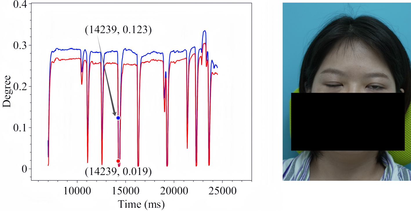 Assistive assessment of neurological dysfunction via eye movement patterns and ocular biometrics