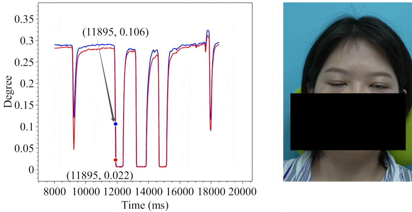 Assistive assessment of neurological dysfunction via eye movement patterns and ocular biometrics