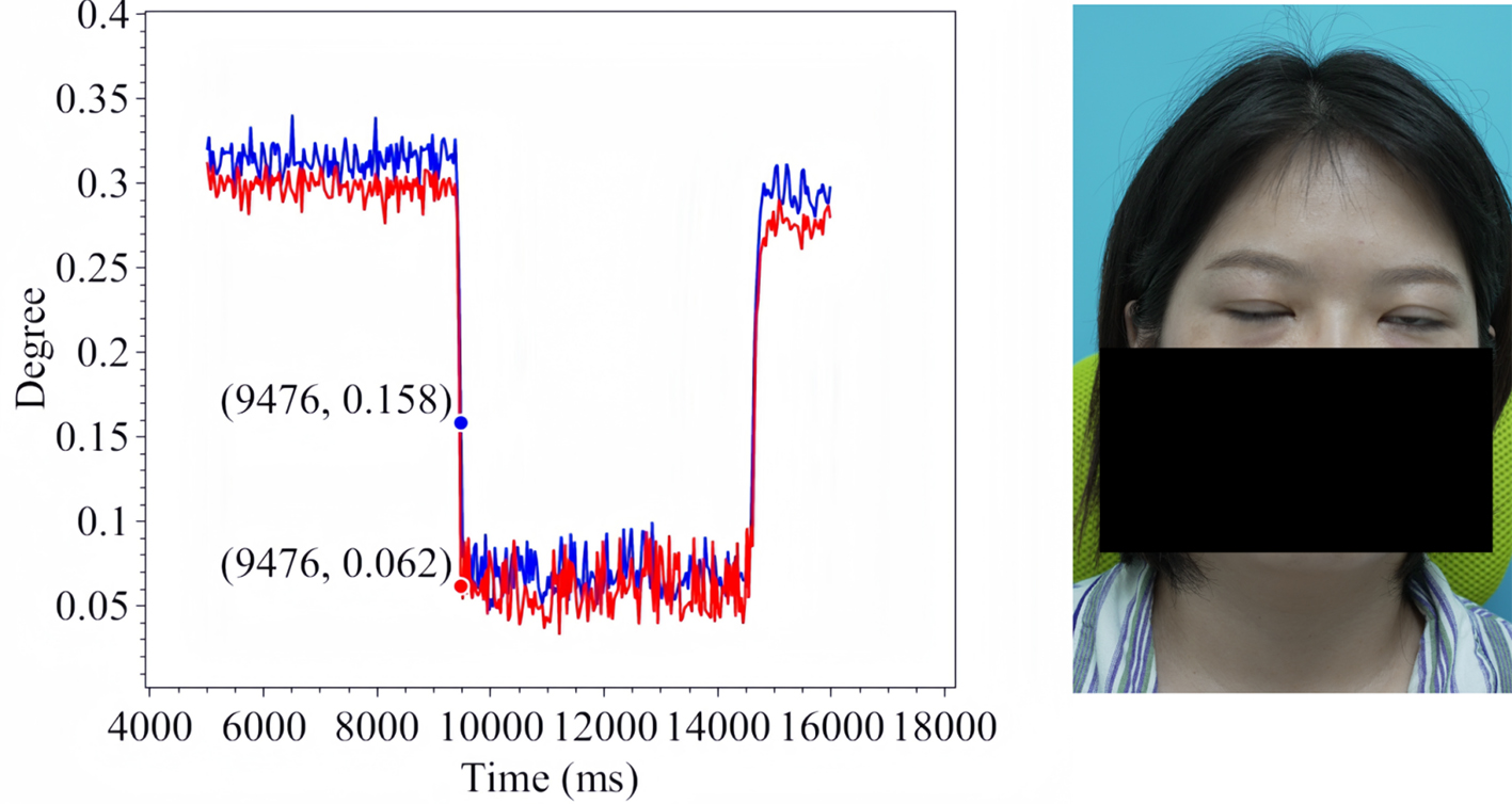 Assistive assessment of neurological dysfunction via eye movement patterns and ocular biometrics