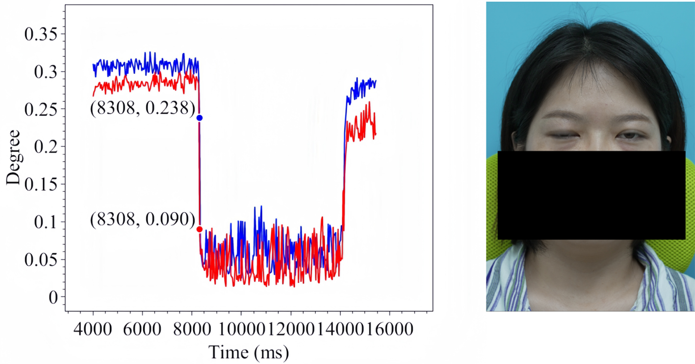 Assistive assessment of neurological dysfunction via eye movement patterns and ocular biometrics