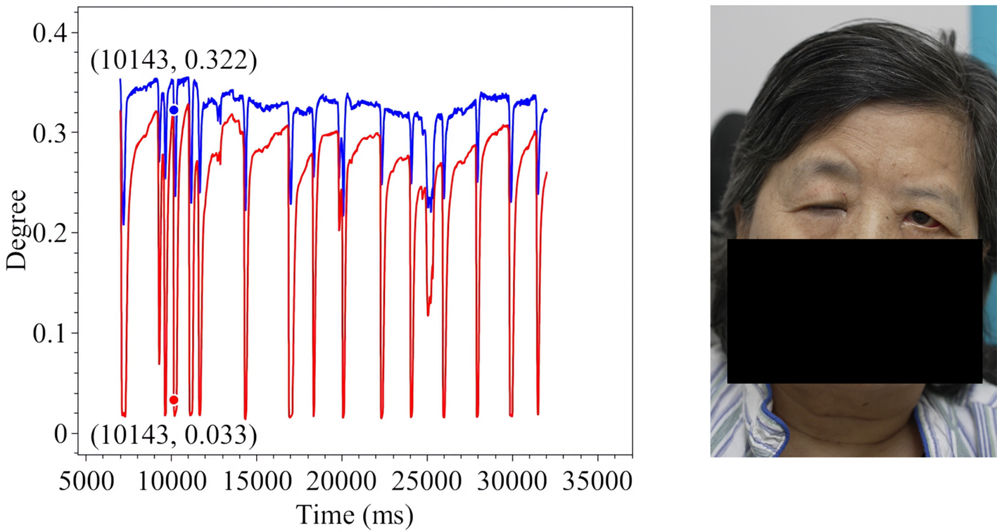 Assistive assessment of neurological dysfunction via eye movement patterns and ocular biometrics