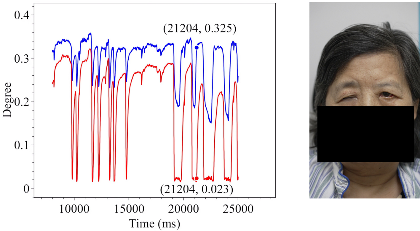 Assistive assessment of neurological dysfunction via eye movement patterns and ocular biometrics