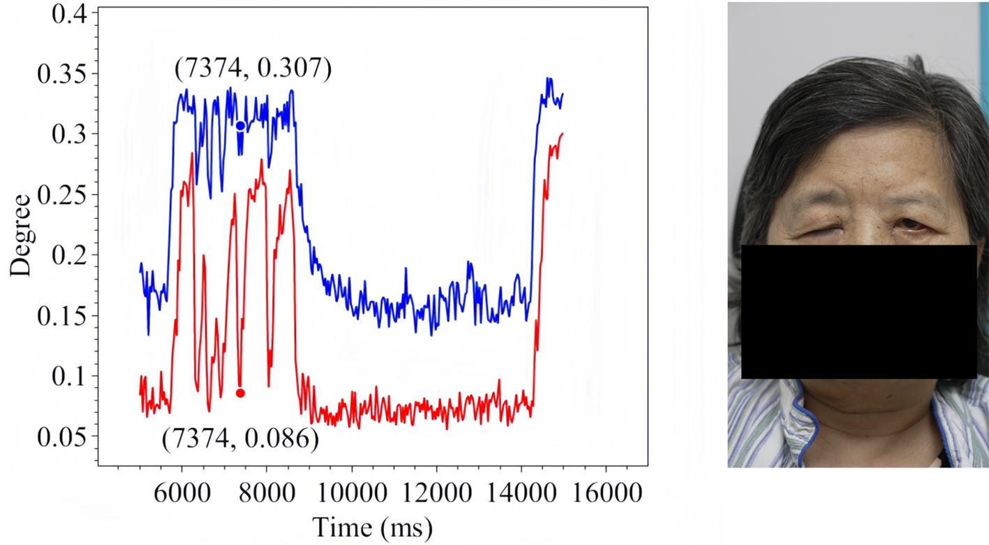 Assistive assessment of neurological dysfunction via eye movement patterns and ocular biometrics