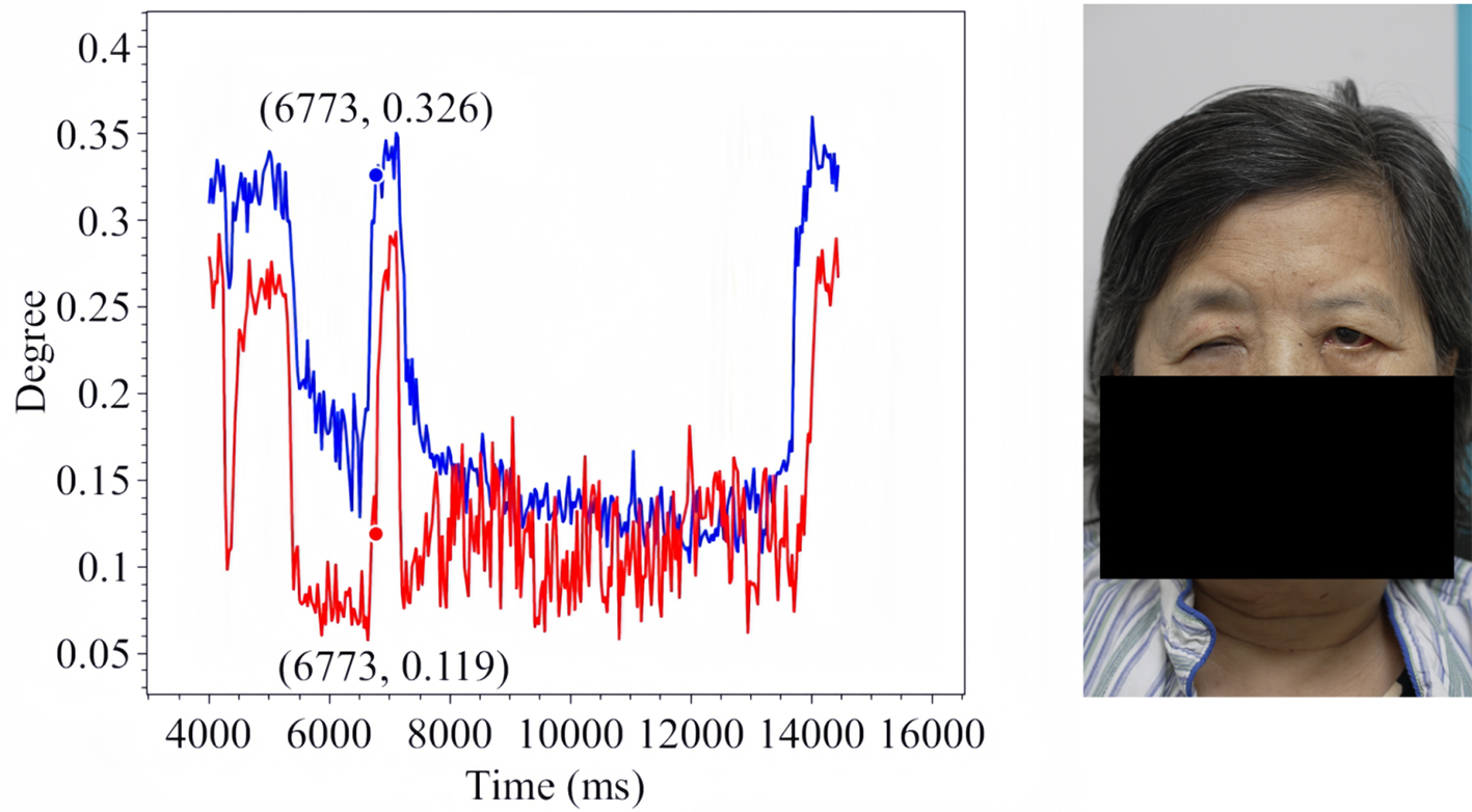Assistive assessment of neurological dysfunction via eye movement patterns and ocular biometrics