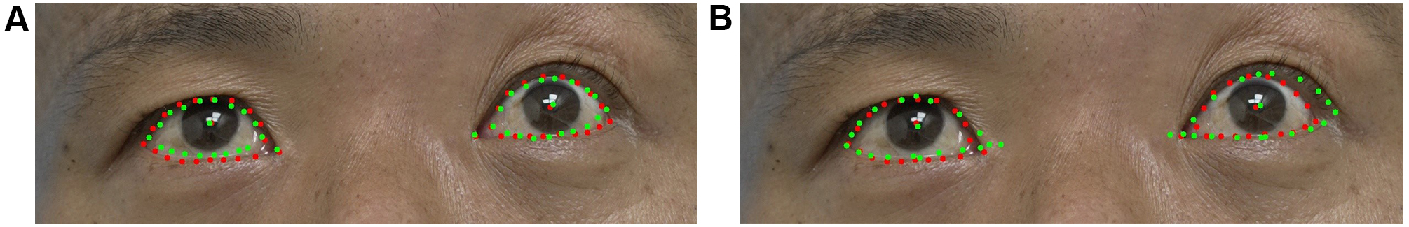 Assistive assessment of neurological dysfunction via eye movement patterns and ocular biometrics