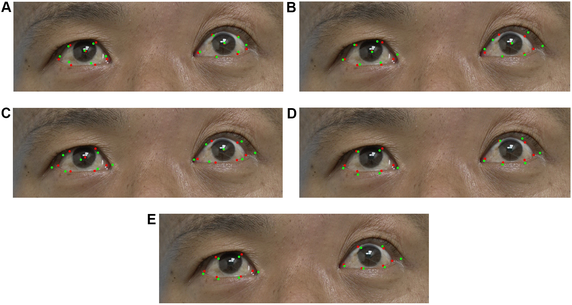 Assistive assessment of neurological dysfunction via eye movement patterns and ocular biometrics