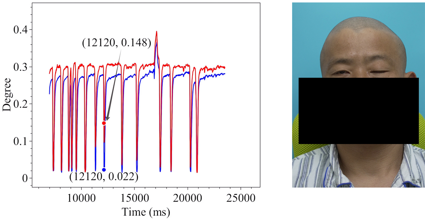 Assistive assessment of neurological dysfunction via eye movement patterns and ocular biometrics