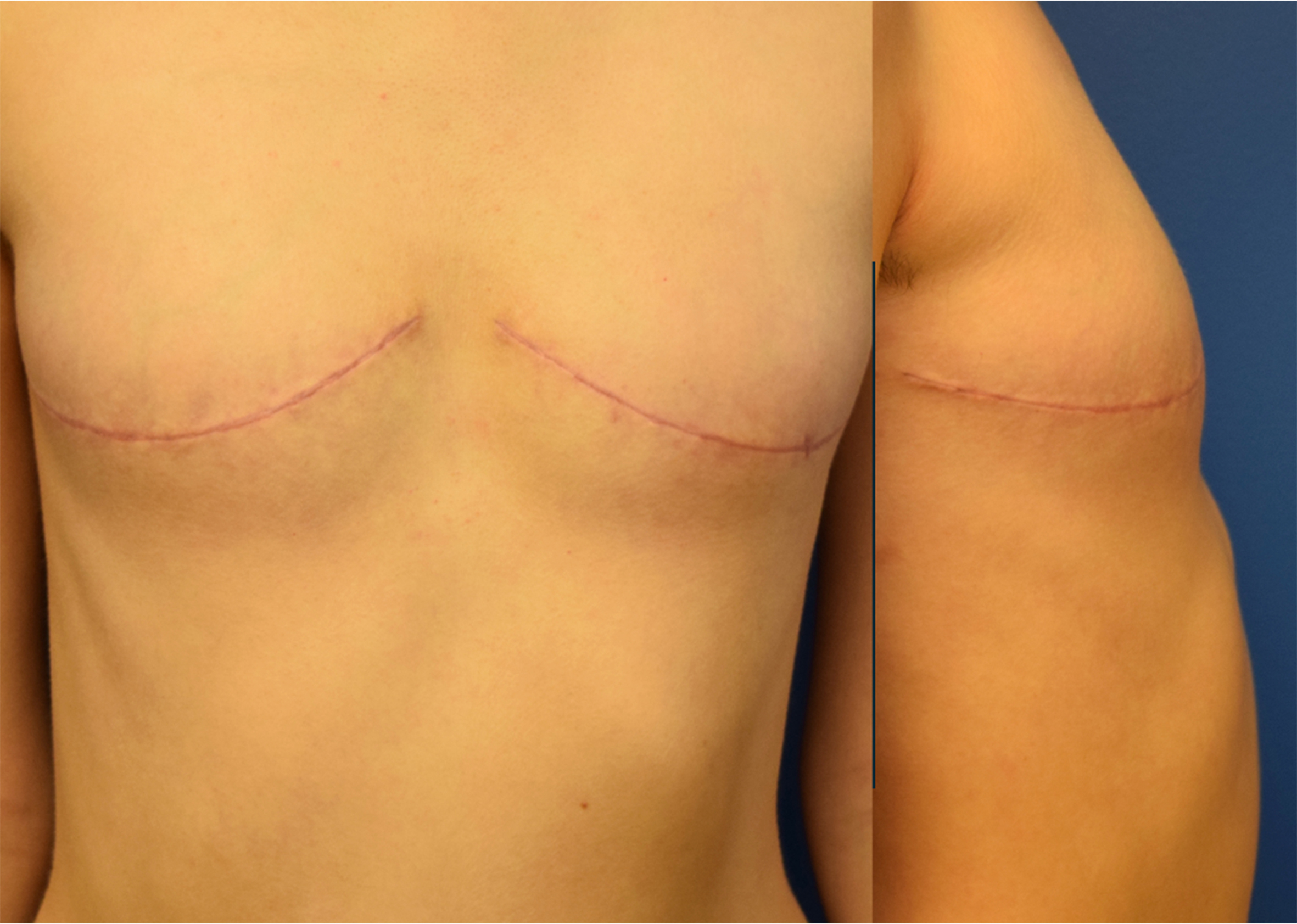 Beyond the double incision mastectomy: a narrative literature review and case series exploring alternative techniques in gender-affirming top surgery