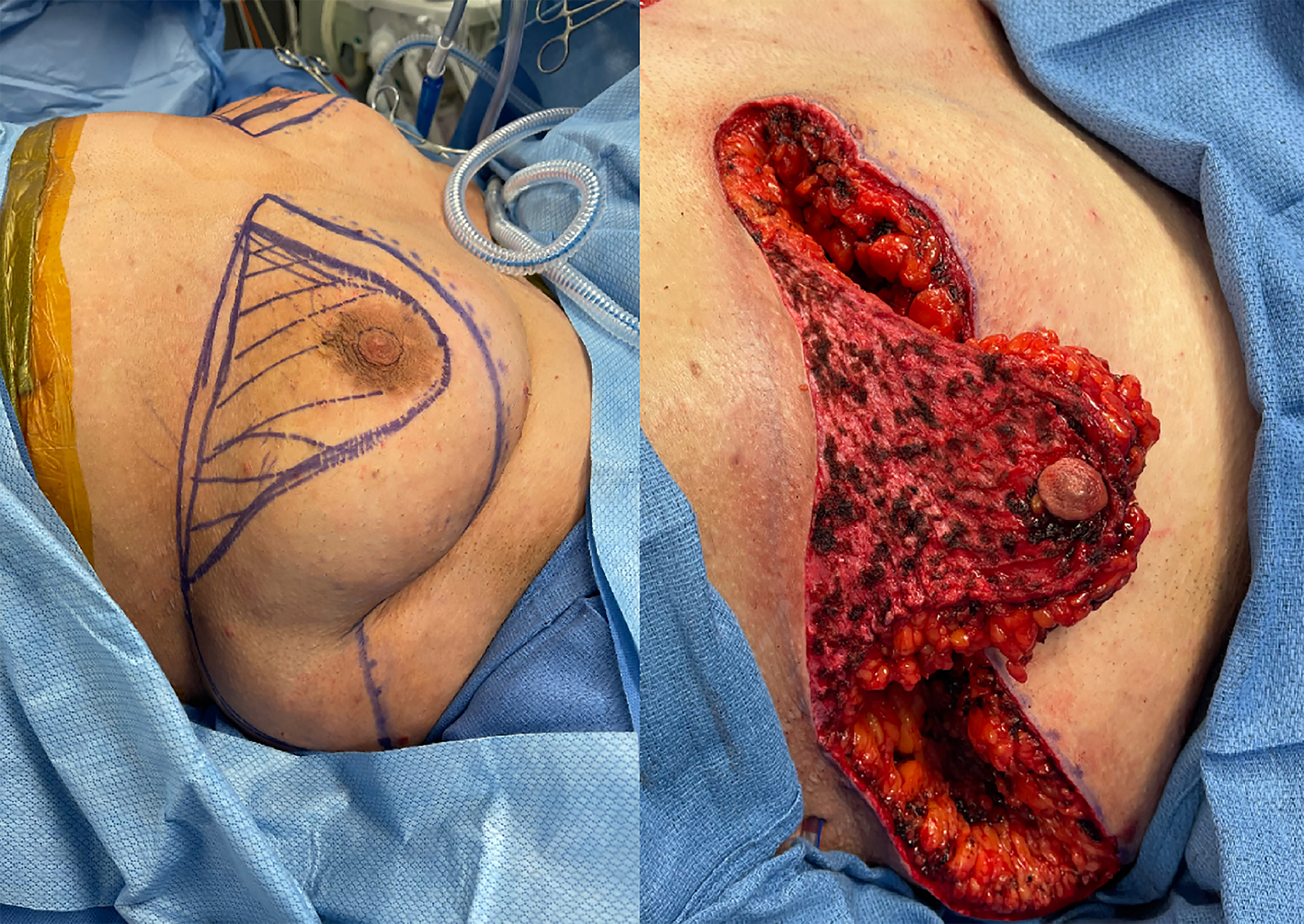 Beyond the double incision mastectomy: a narrative literature review and case series exploring alternative techniques in gender-affirming top surgery