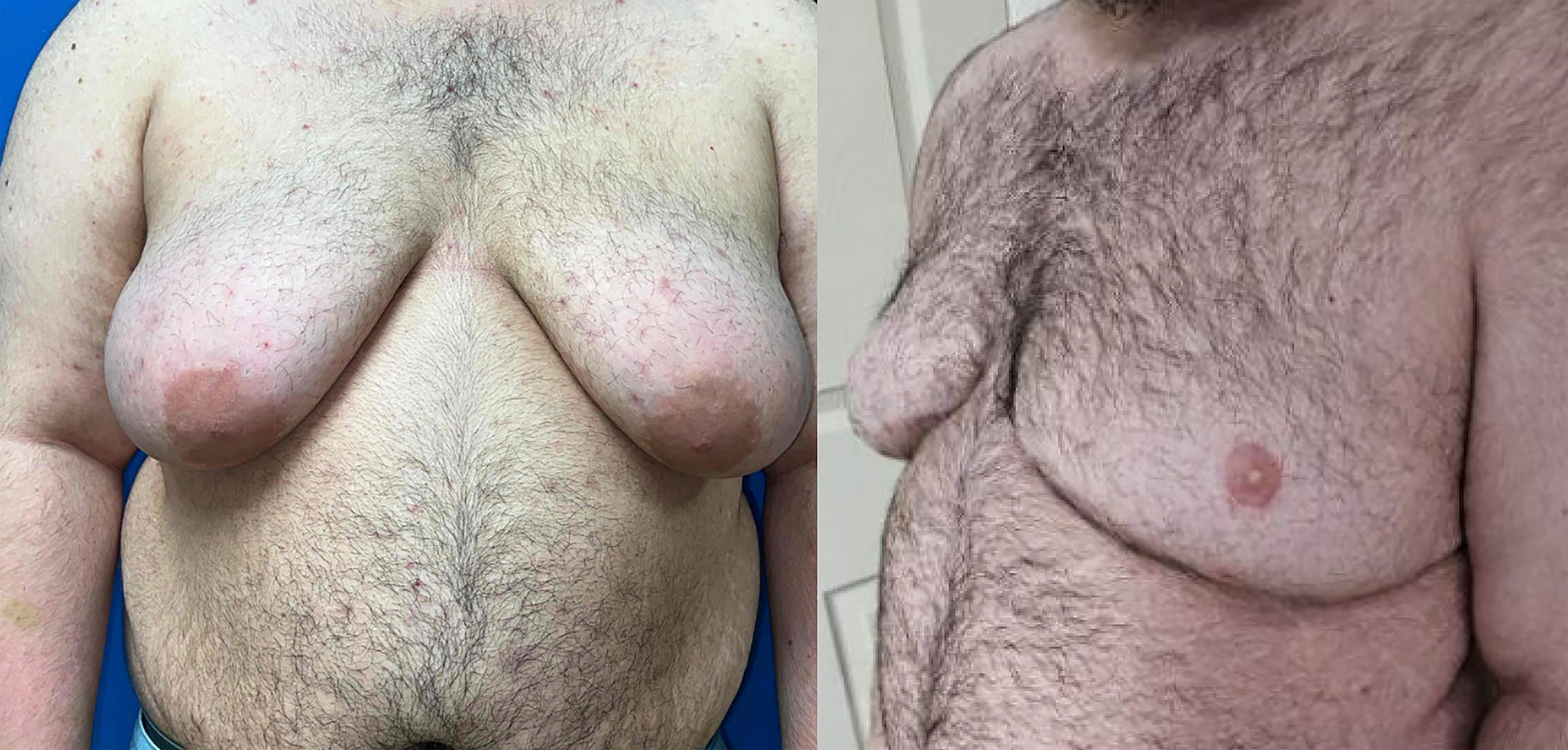 Beyond the double incision mastectomy: a narrative literature review and case series exploring alternative techniques in gender-affirming top surgery