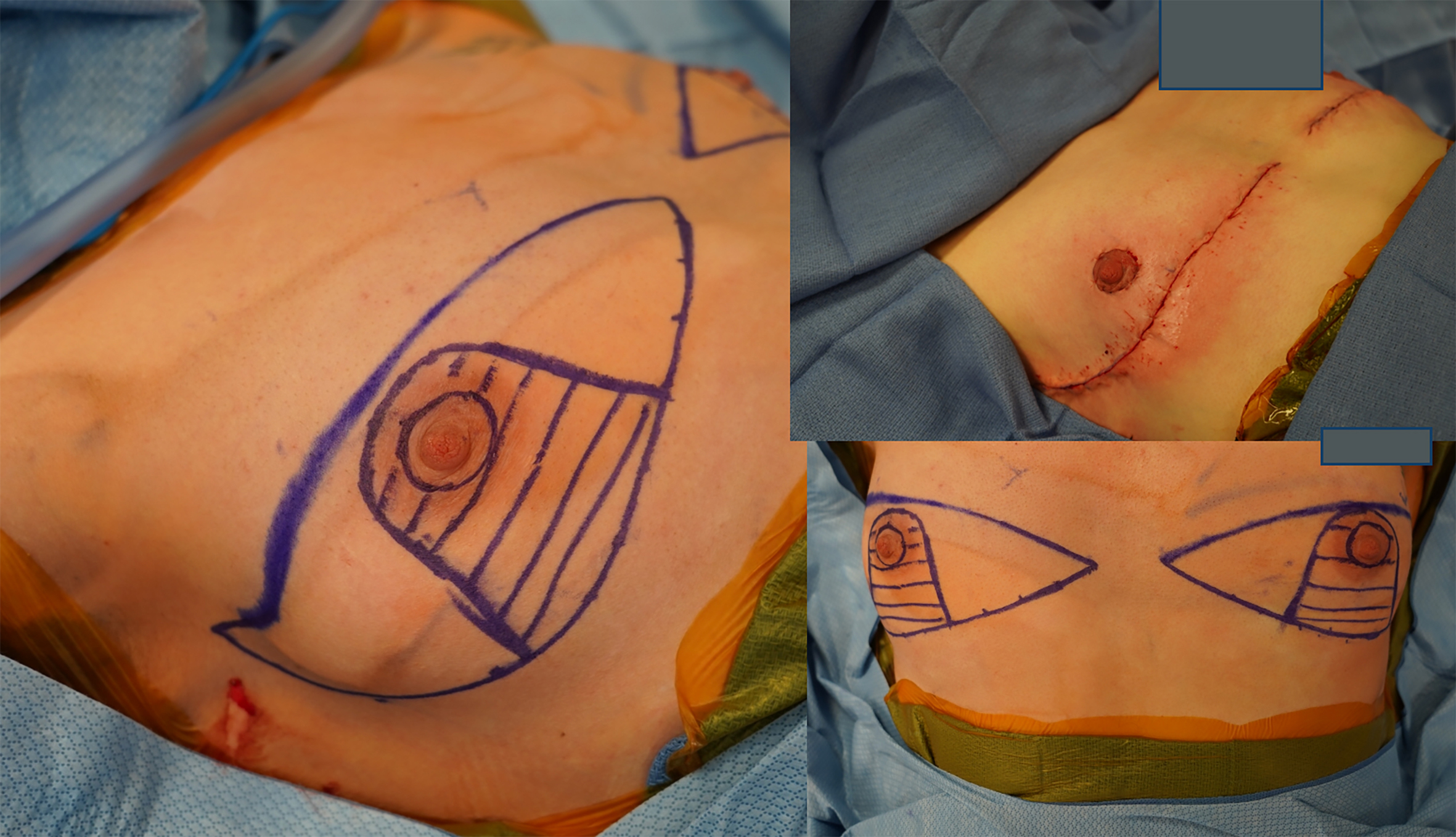 Beyond the double incision mastectomy: a narrative literature review and case series exploring alternative techniques in gender-affirming top surgery
