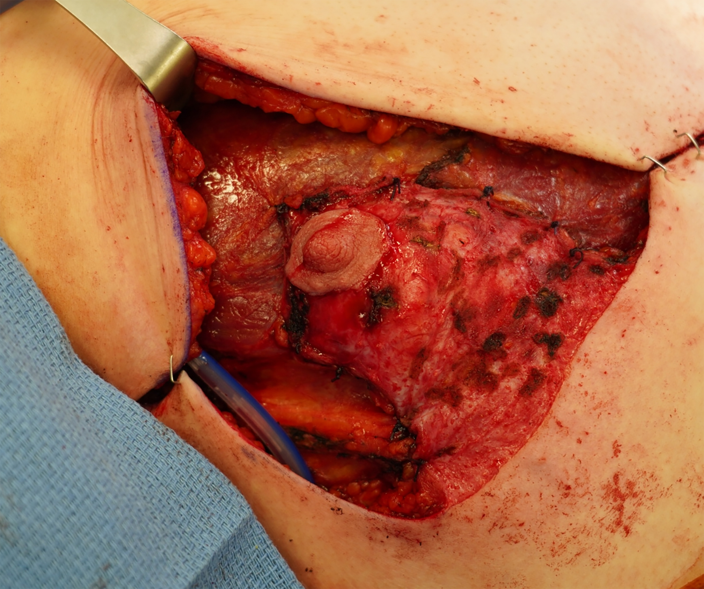 Beyond the double incision mastectomy: a narrative literature review and case series exploring alternative techniques in gender-affirming top surgery