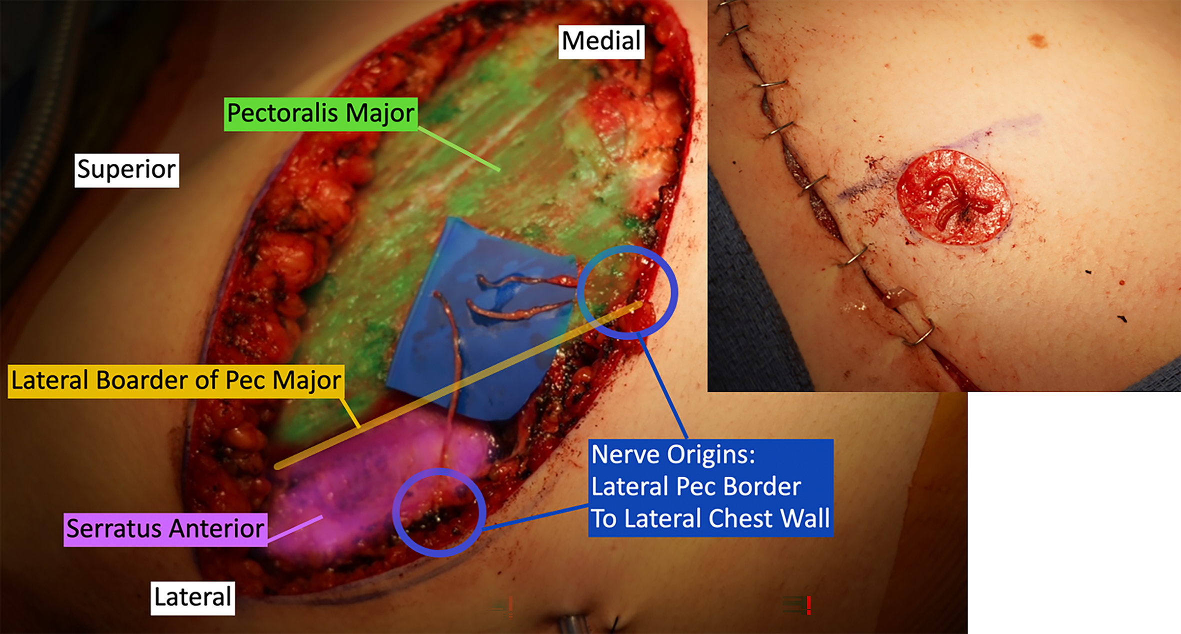 Beyond the double incision mastectomy: a narrative literature review and case series exploring alternative techniques in gender-affirming top surgery