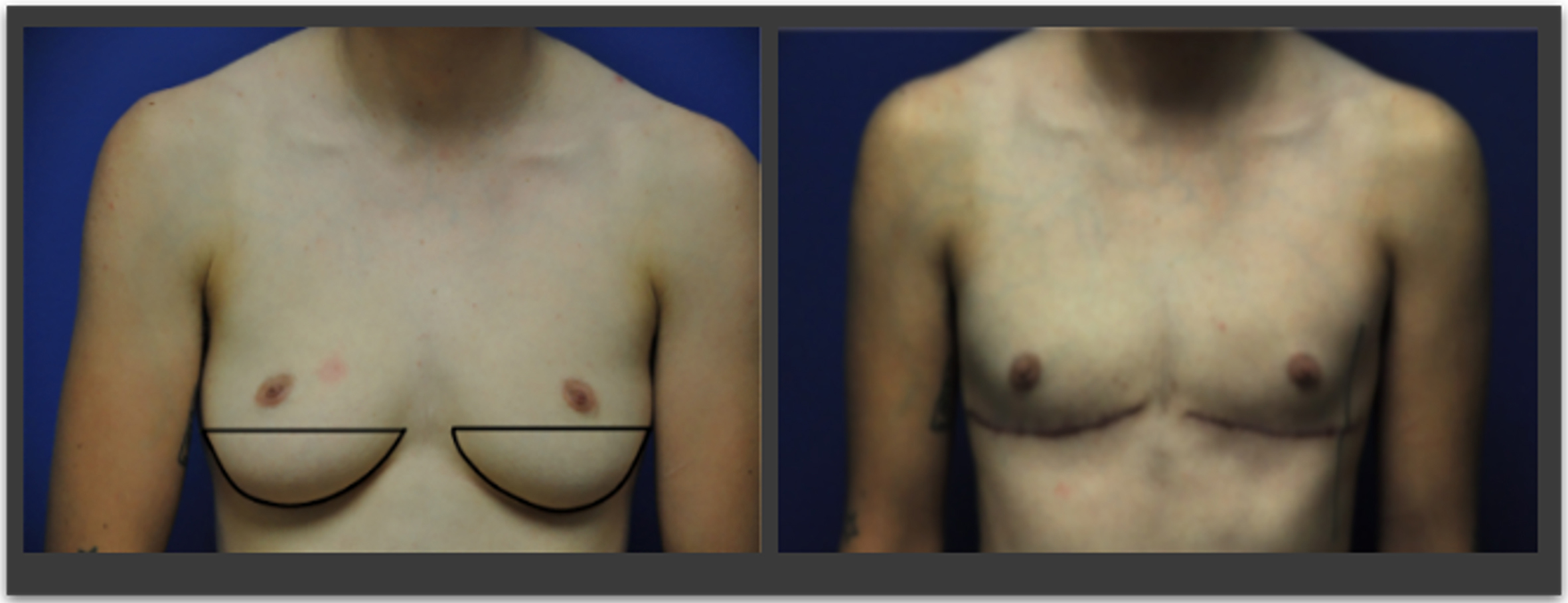 Beyond the double incision mastectomy: a narrative literature review and case series exploring alternative techniques in gender-affirming top surgery
