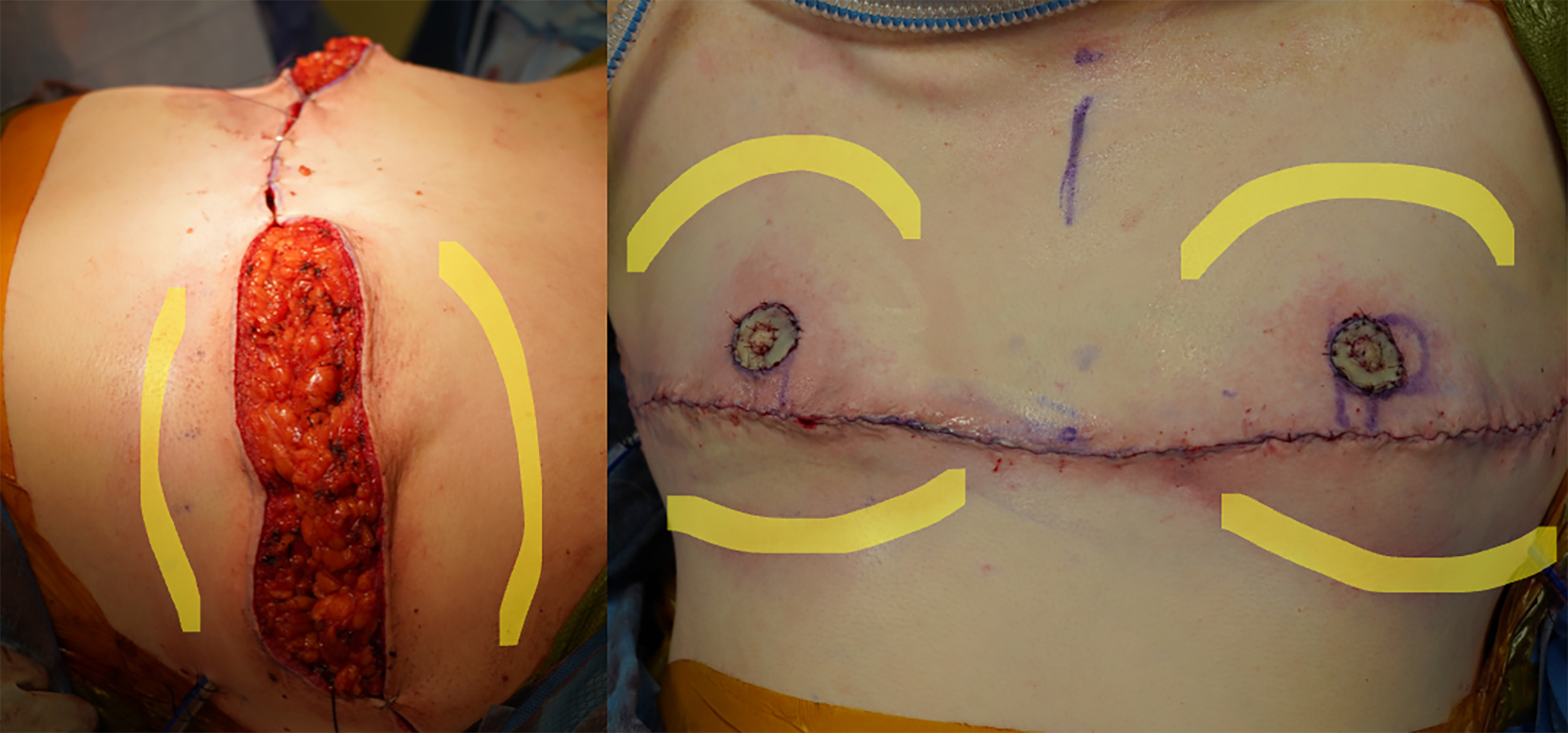 Beyond the double incision mastectomy: a narrative literature review and case series exploring alternative techniques in gender-affirming top surgery