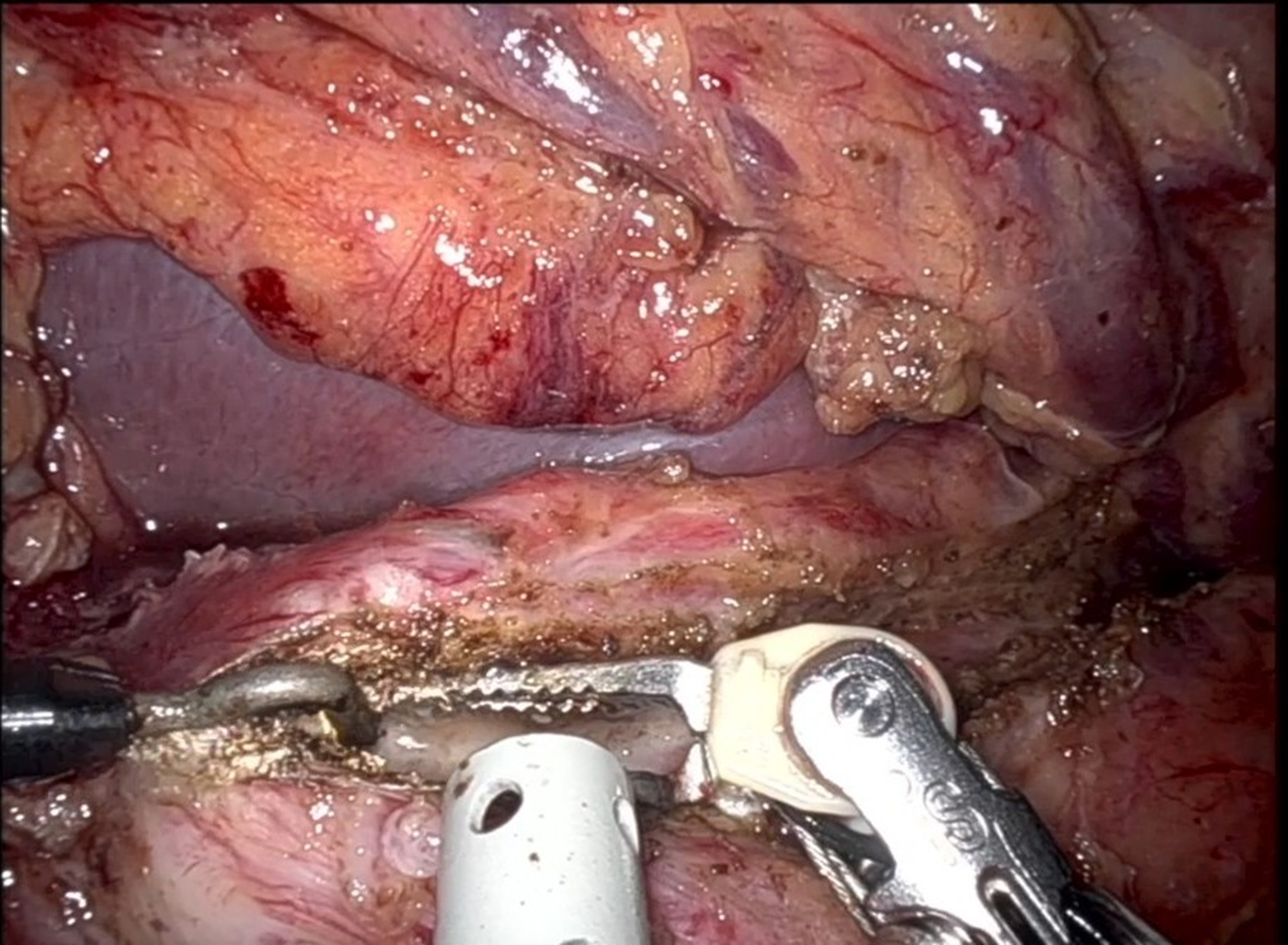 Robot-assisted Partington-Rochelle procedure for chronic pancreatitis: a technical note with video presentation