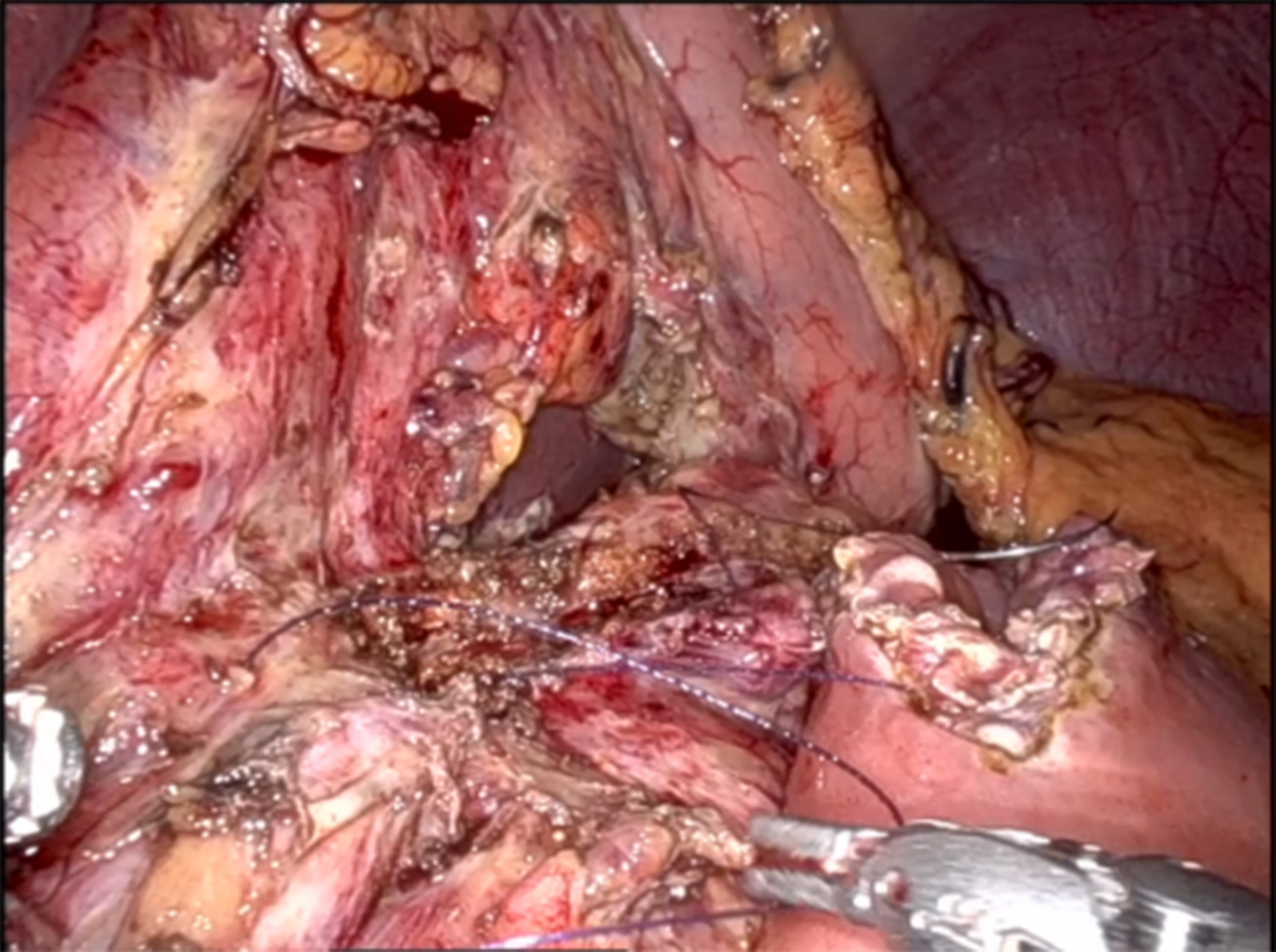 Robot-assisted Partington-Rochelle procedure for chronic pancreatitis: a technical note with video presentation