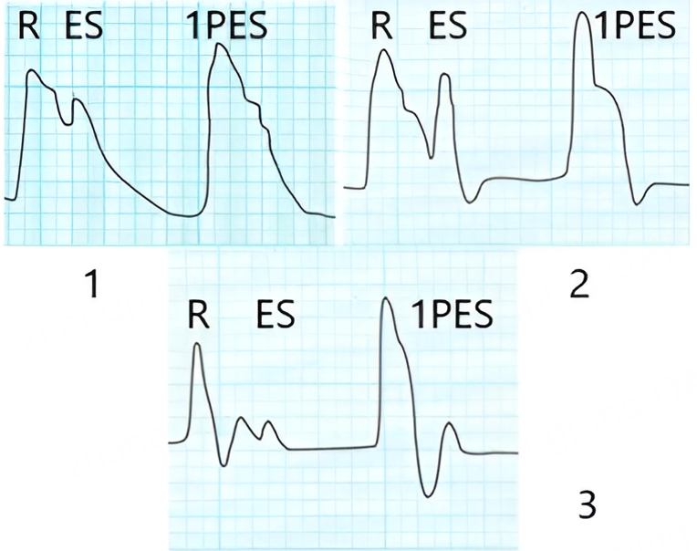 Functional classification of extrasystoles based on hemodynamic features and risk of arterial vascular complications