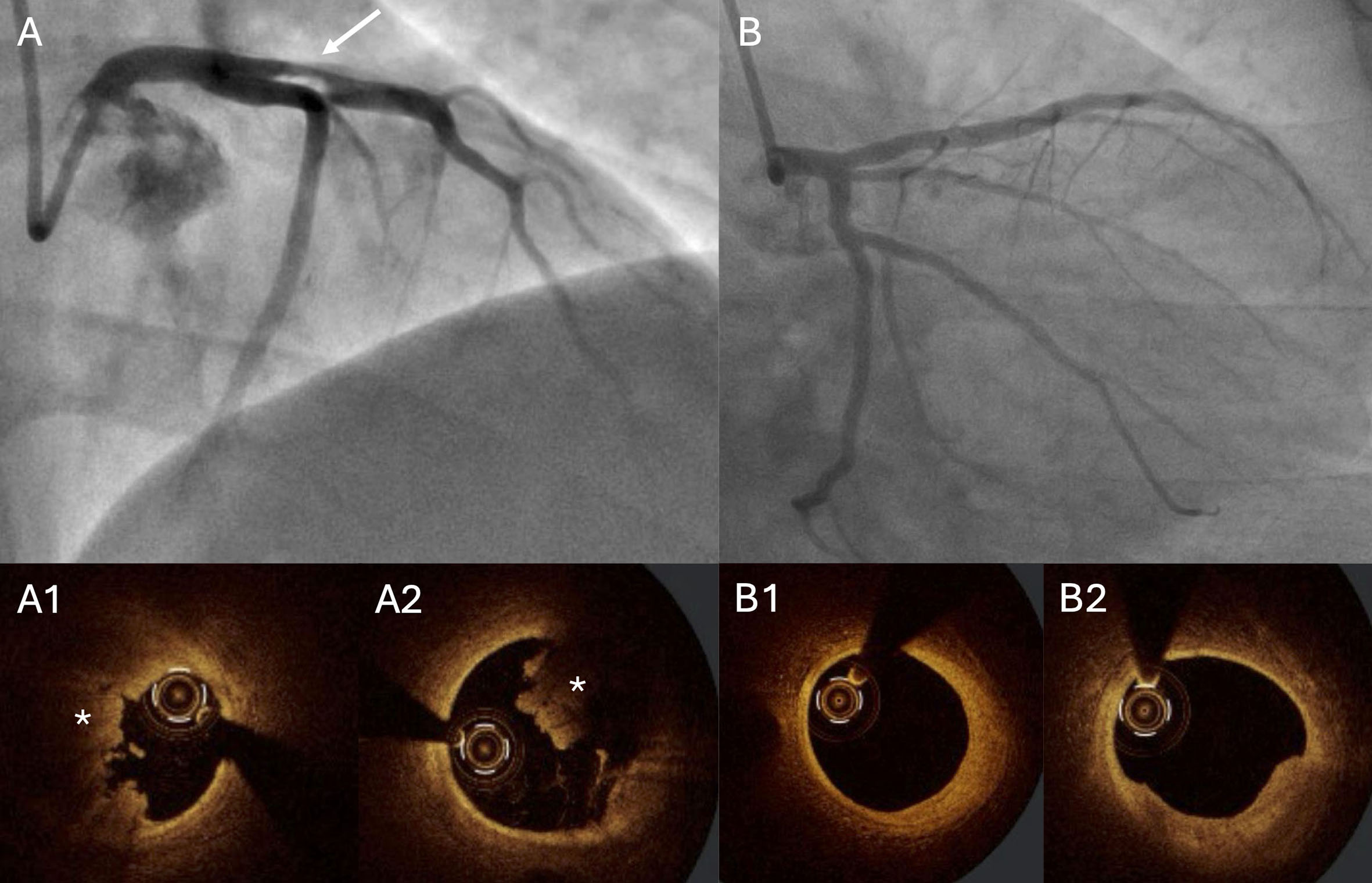 Invasive assessment of culprit and non-culprit coronary lesions in patients with acute coronary syndromes