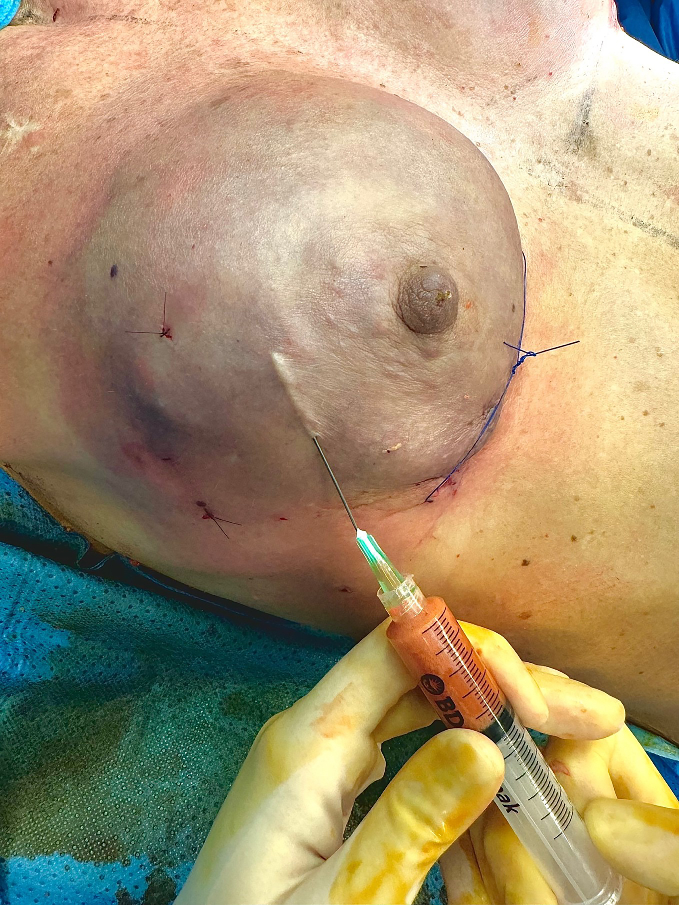 Optimizing aesthetic outcomes in immediate prepectoral breast reconstruction using sharp-needle intradermal fat grafting: a clinical experience