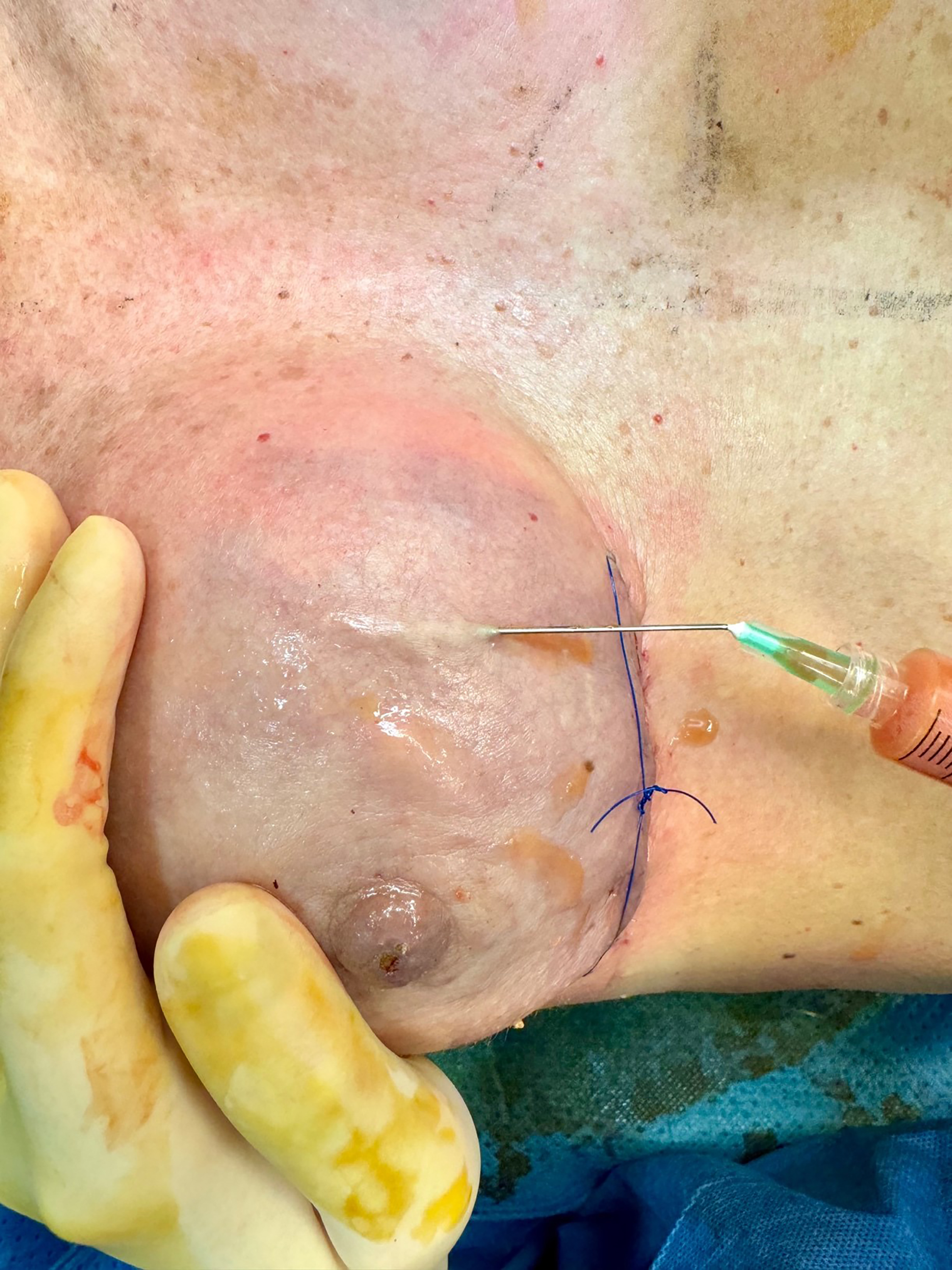 Optimizing aesthetic outcomes in immediate prepectoral breast reconstruction using sharp-needle intradermal fat grafting: a clinical experience