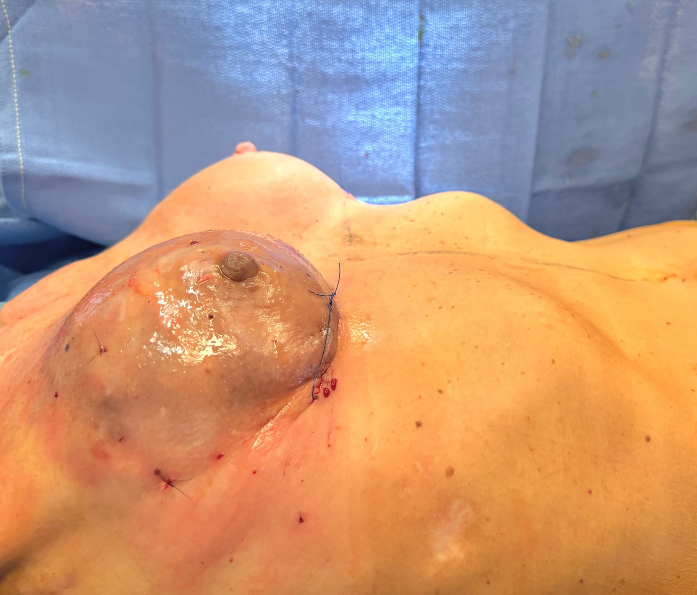 Optimizing aesthetic outcomes in immediate prepectoral breast reconstruction using sharp-needle intradermal fat grafting: a clinical experience