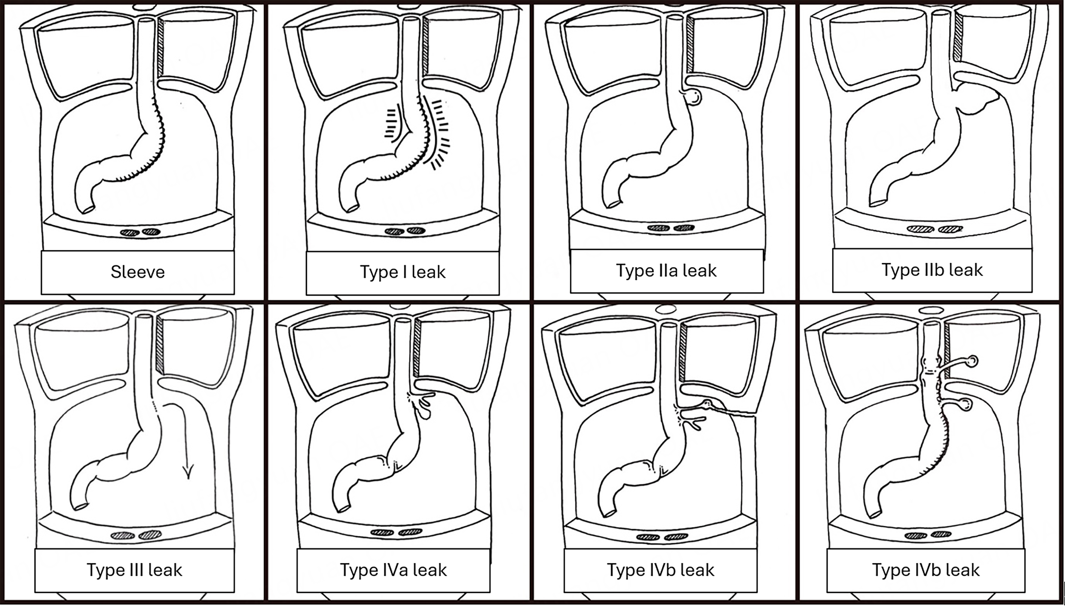 Stage dependent management of sleeve gastrectomy leaks - a systematic review with proposed classification and management algorithm